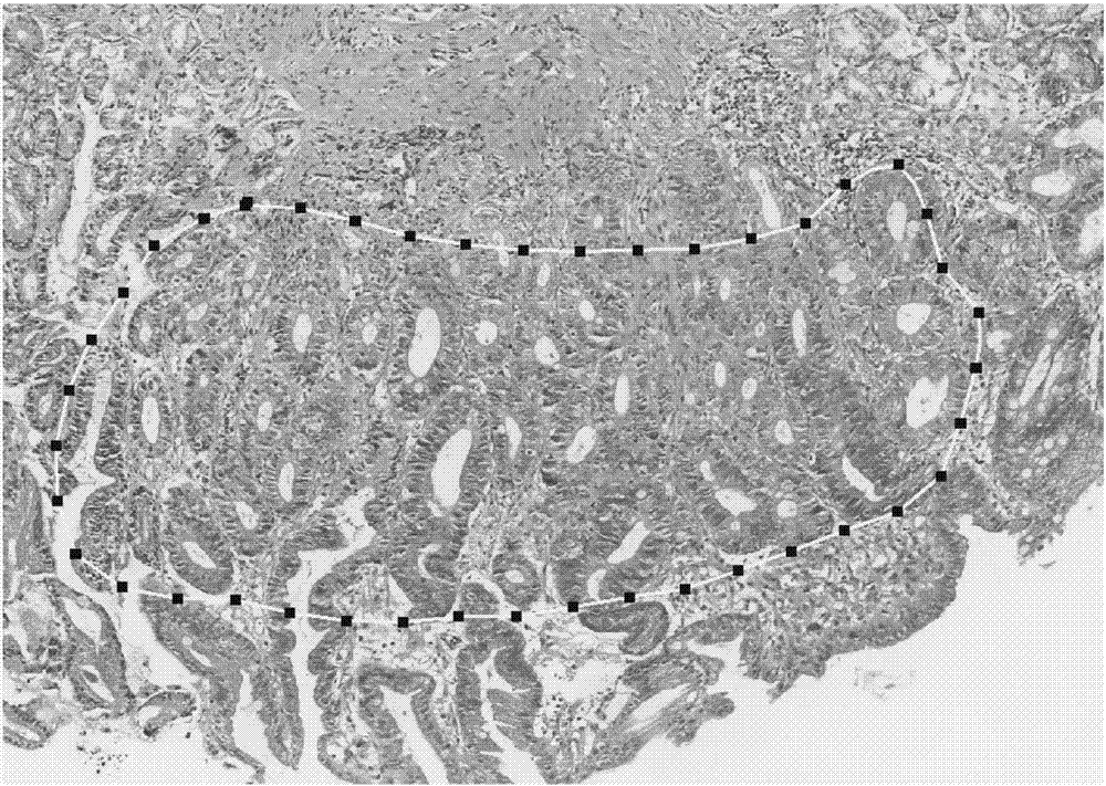 Benign gastritis pathological diagnosis support system and method based on big data deep learning