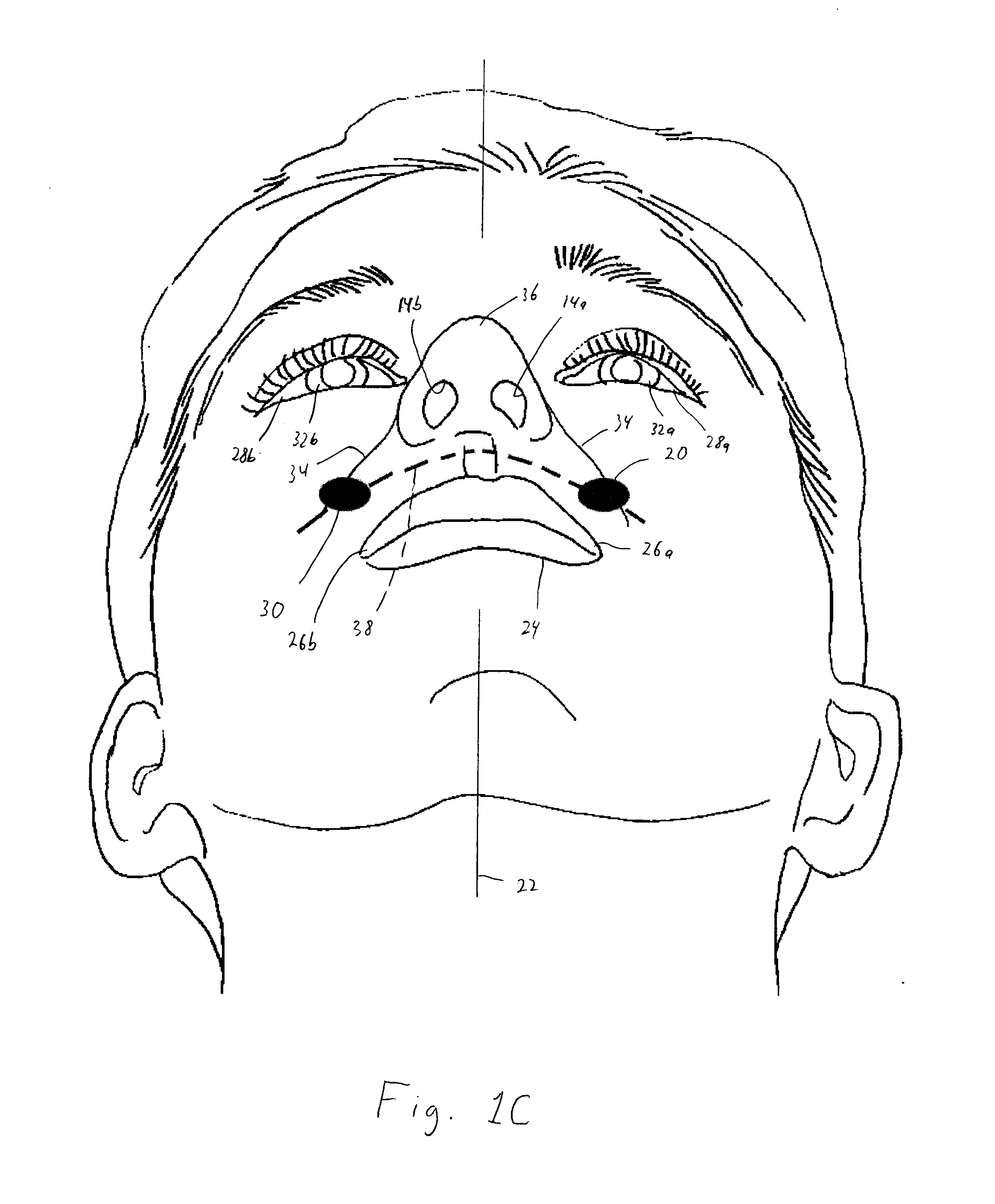 Patient interface device with limited support area on the face