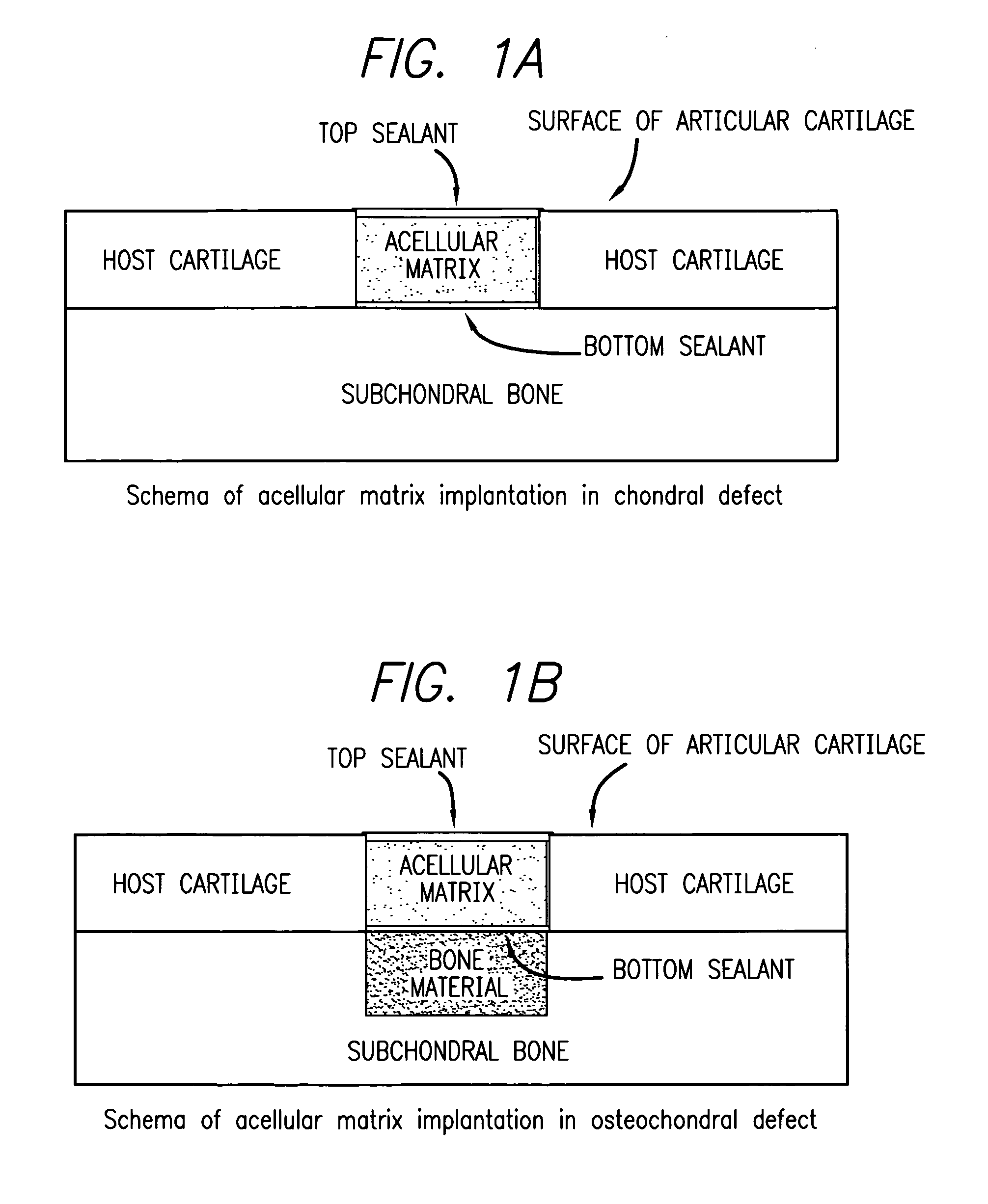 Method for treatment of osteochondral and bone defects using an acellular matrix implant