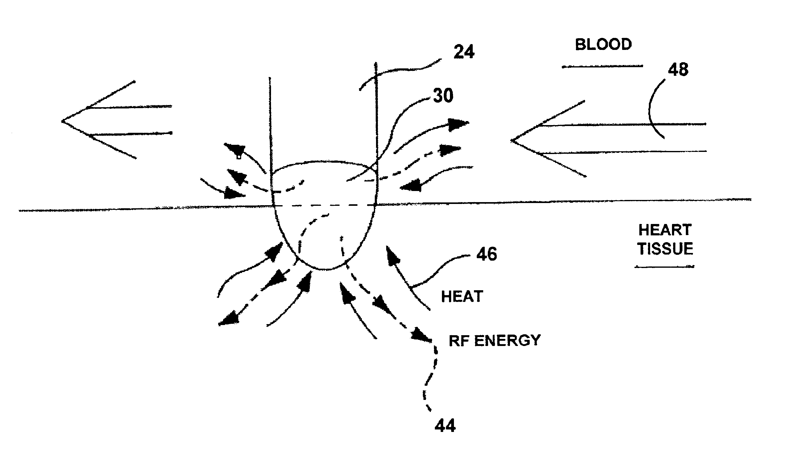 Detecting coagulum formation