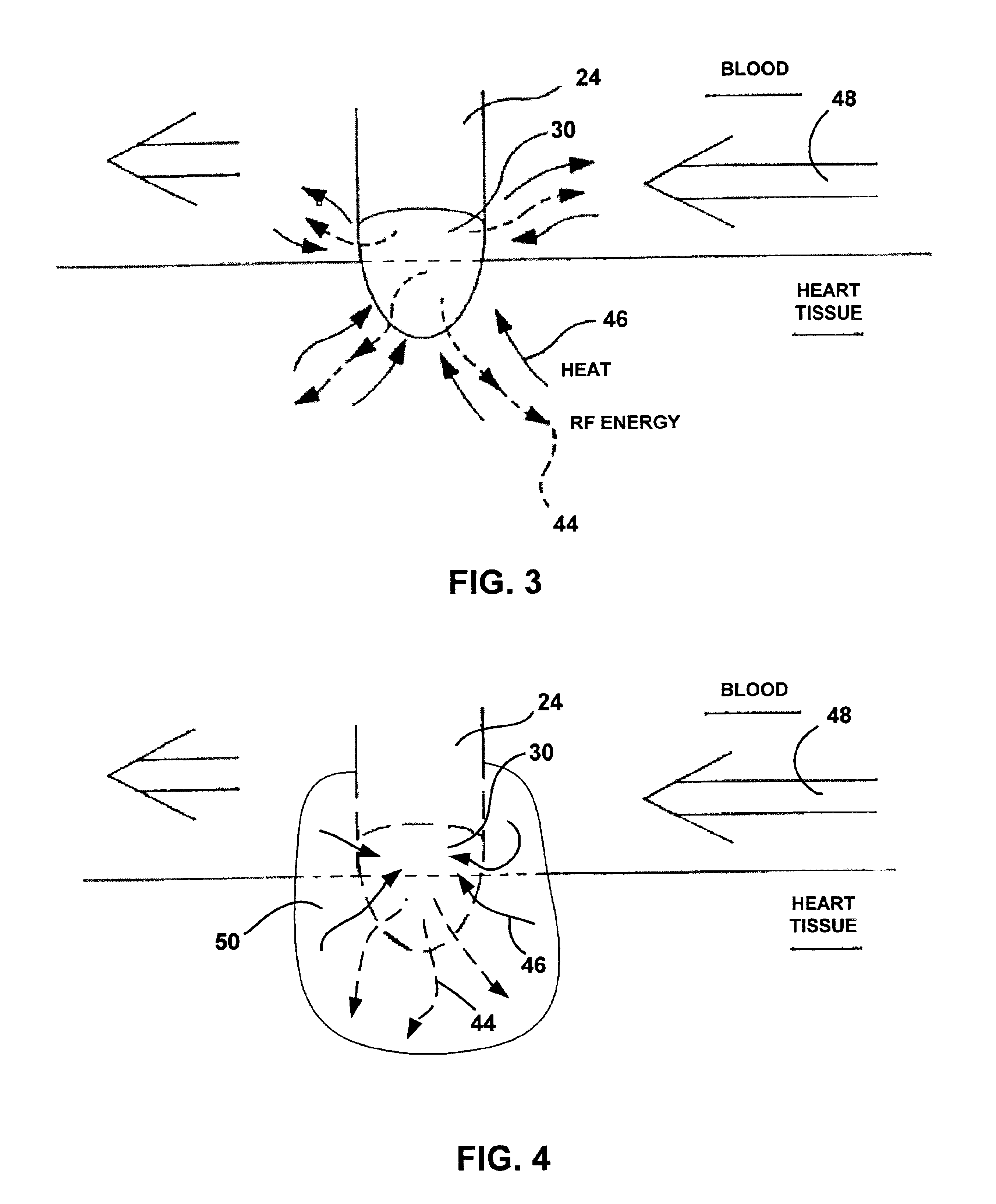 Detecting coagulum formation