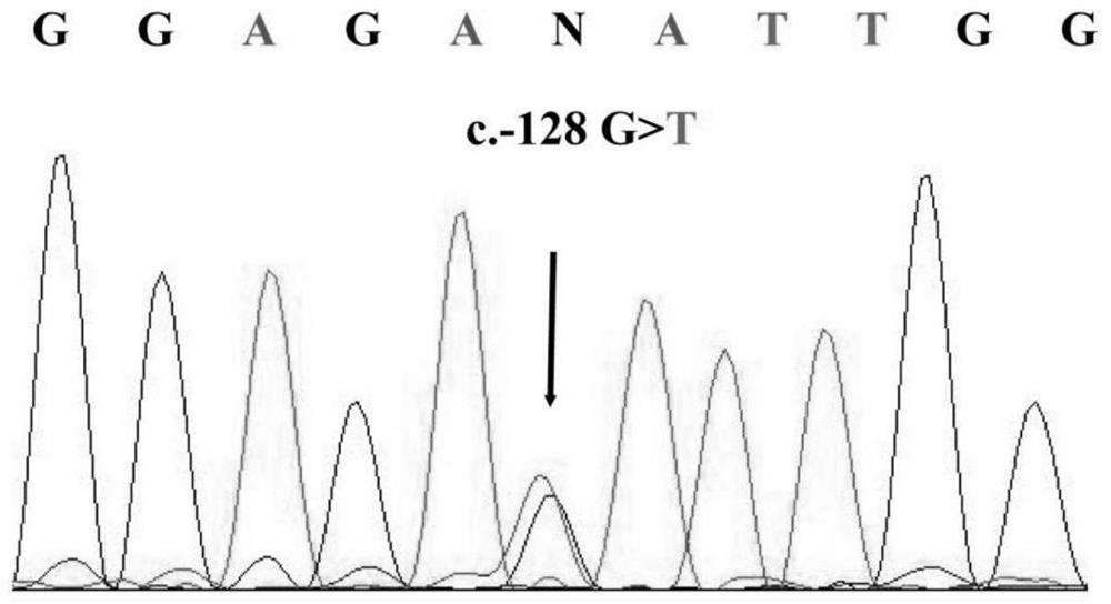 Human II-type thrombocytopenia iPS cell line and preparation method and application thereof