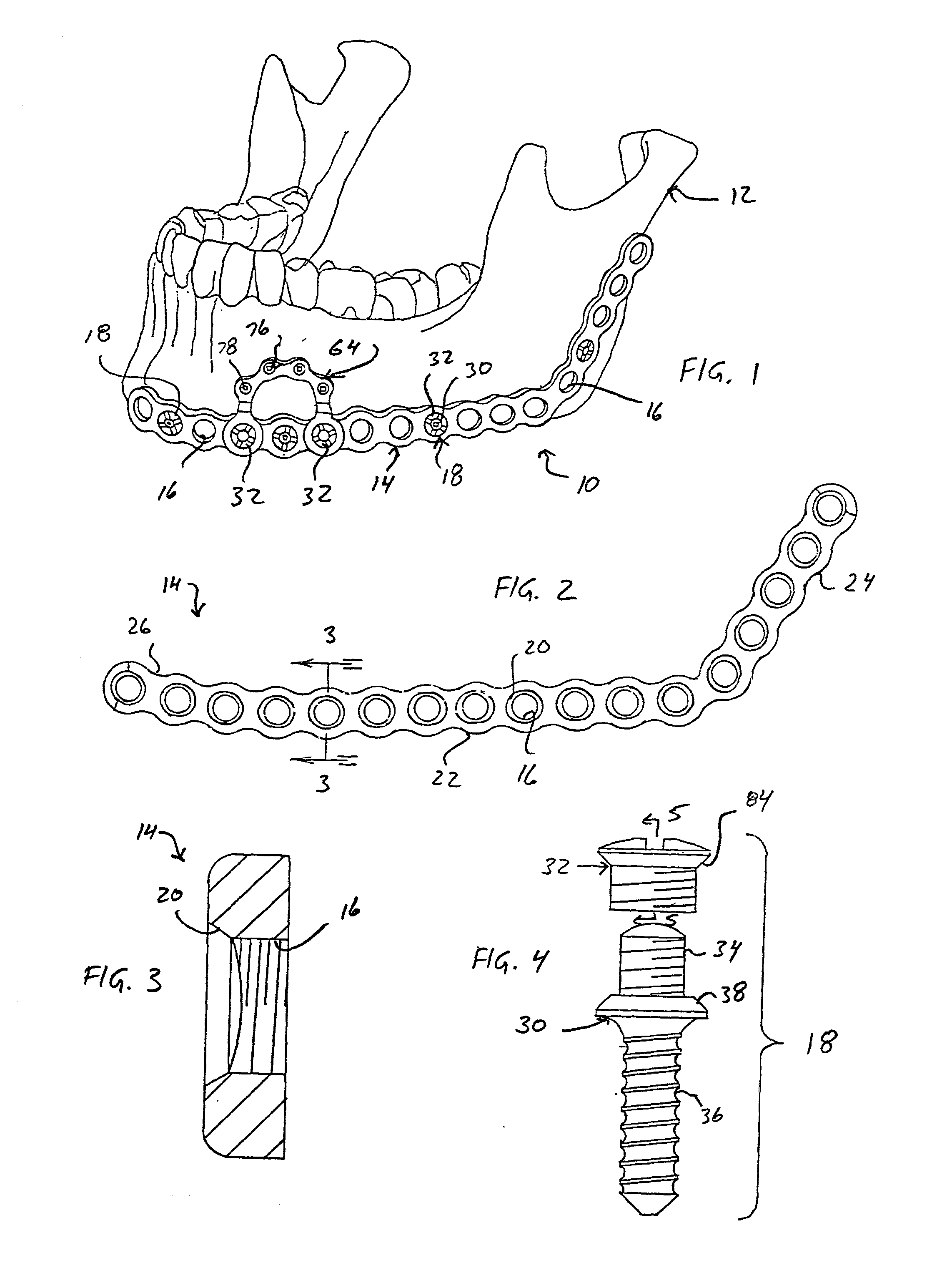 Method and apparatus for mandibular osteosynthesis