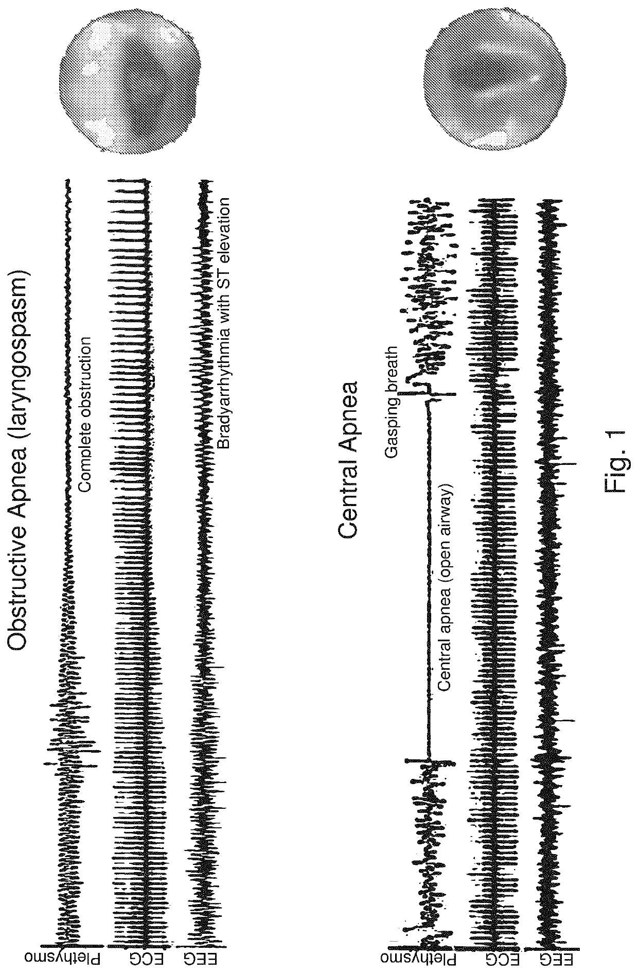 Acute pulmonary pressurization device and method of use