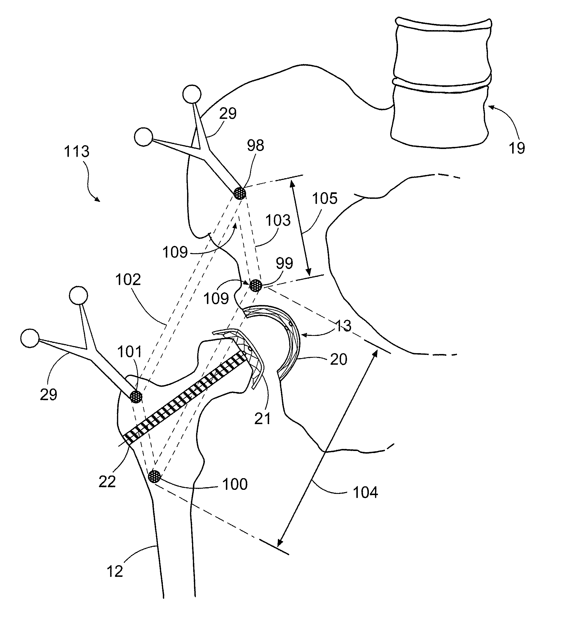 Apparatus for arthroscopic assisted arthroplasty of the hip joint