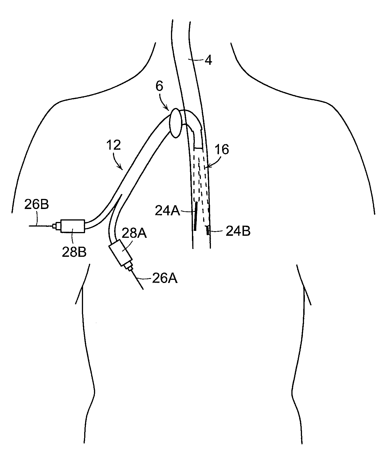 Methods and apparatus for inserting multi-lumen split-tip catheters into a blood vessel