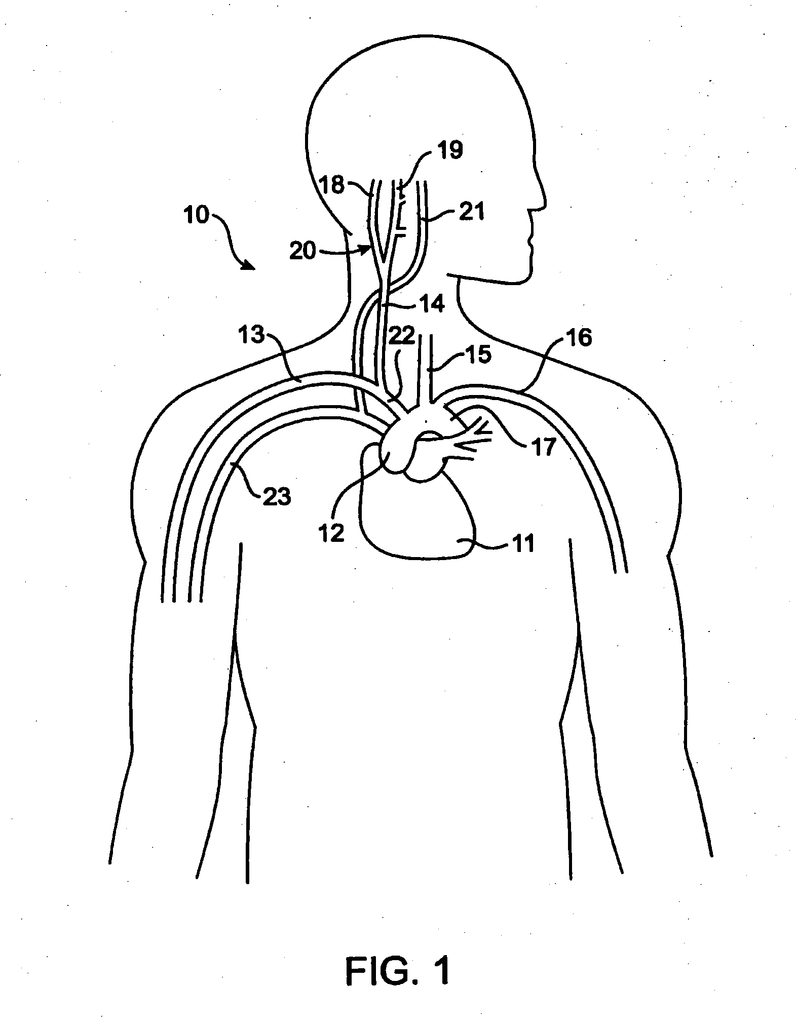 Devices and methods for cardiovascular reflex control via coupled electrodes