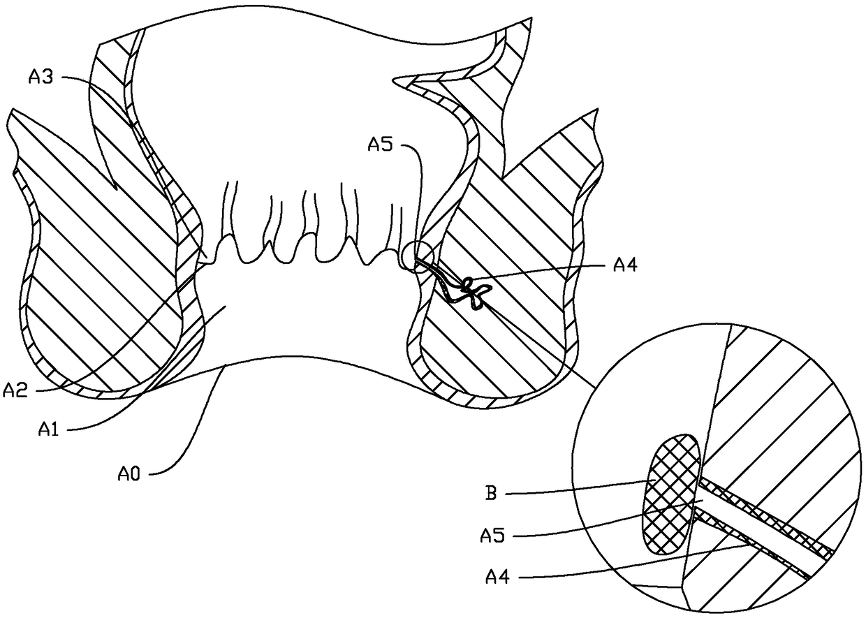 Device acting on anal sinuses