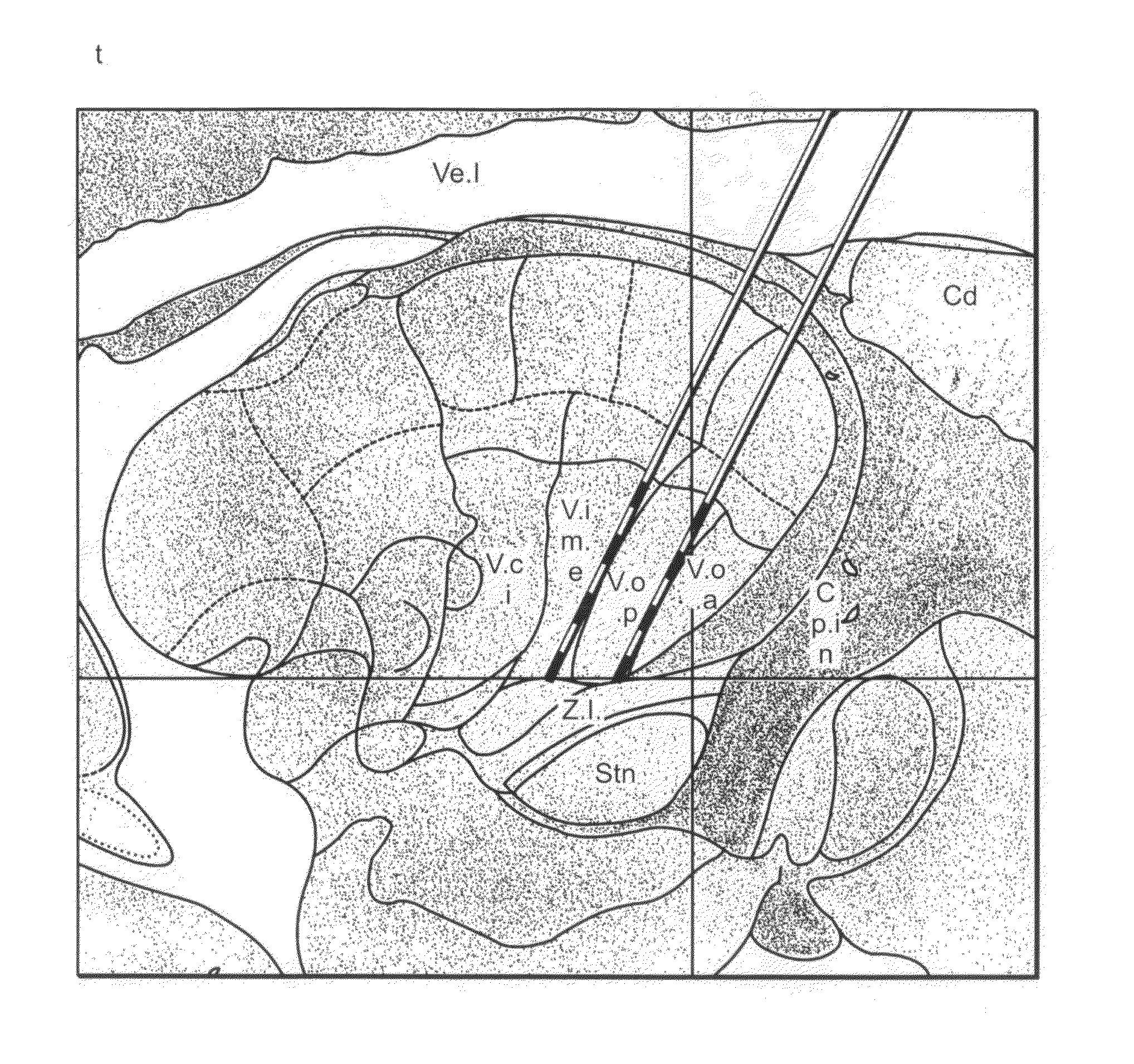 Multiple lead method for deep brain stimulation