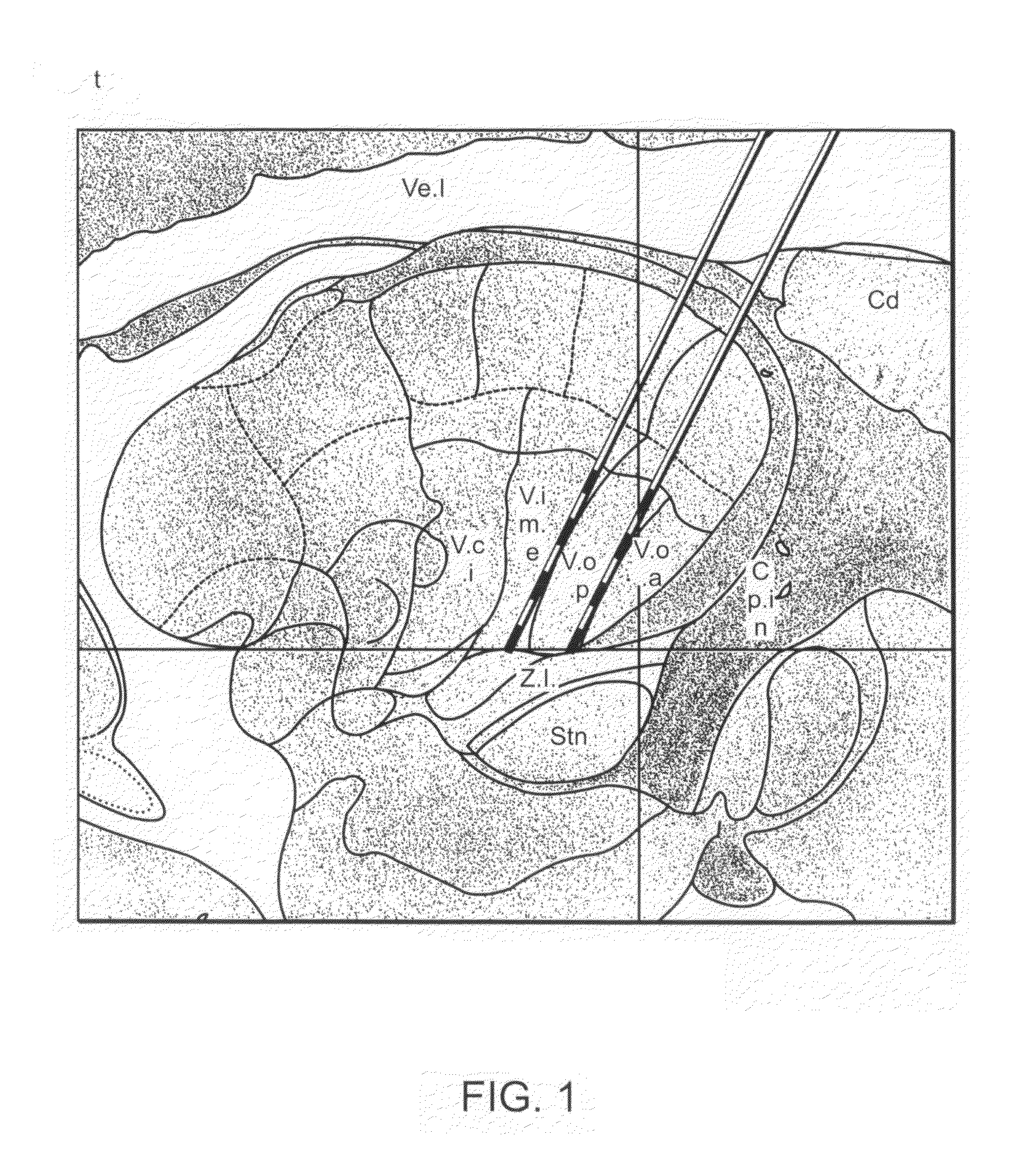 Multiple lead method for deep brain stimulation