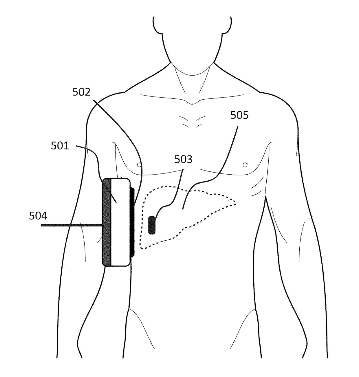 Apparatus and method for in-vivo fat and iron content measurement