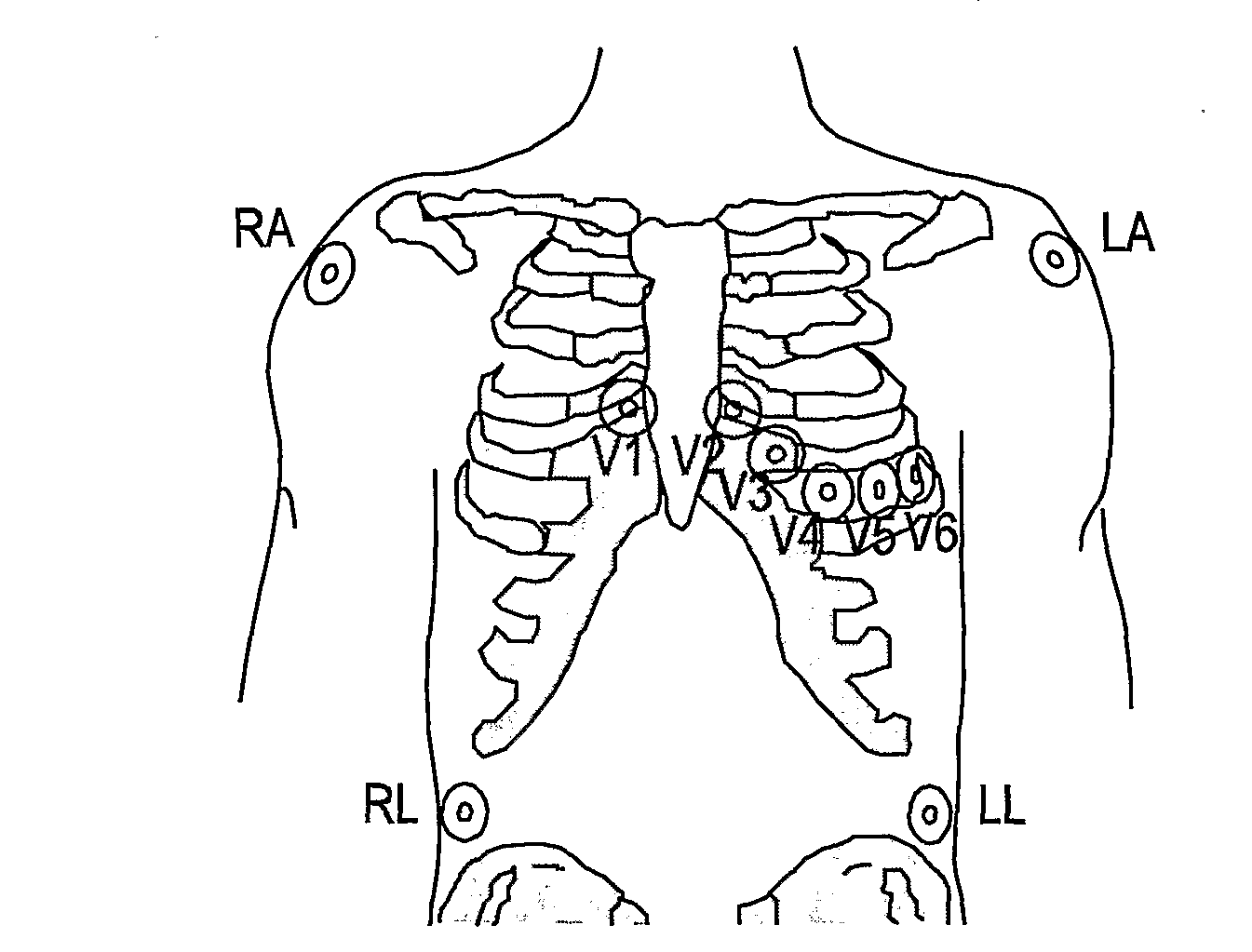 System and method for wireless generation of standard ECG leads and an ECG sensing unit therefor