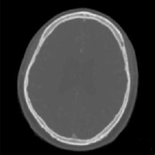 Skull defect reconstruction method based on three-dimensional convolutional neural network