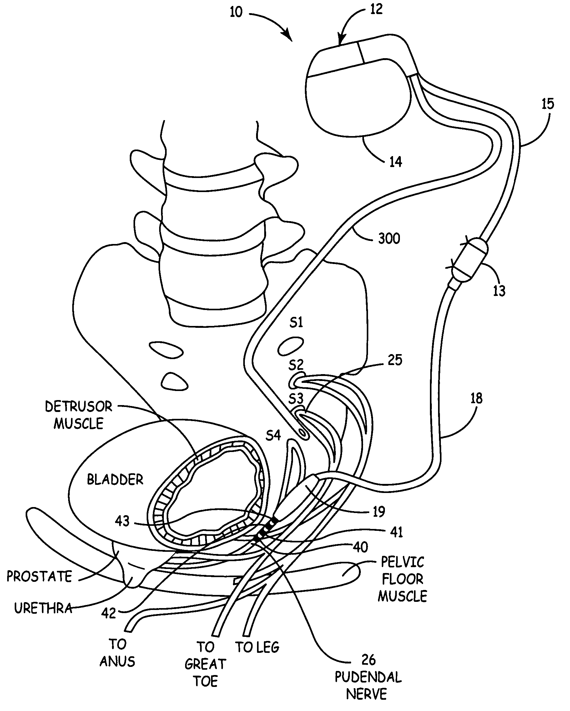 Method, system and device for treating disorders of the pelvic floor by drug delivery to the pudendal and sacral nerves