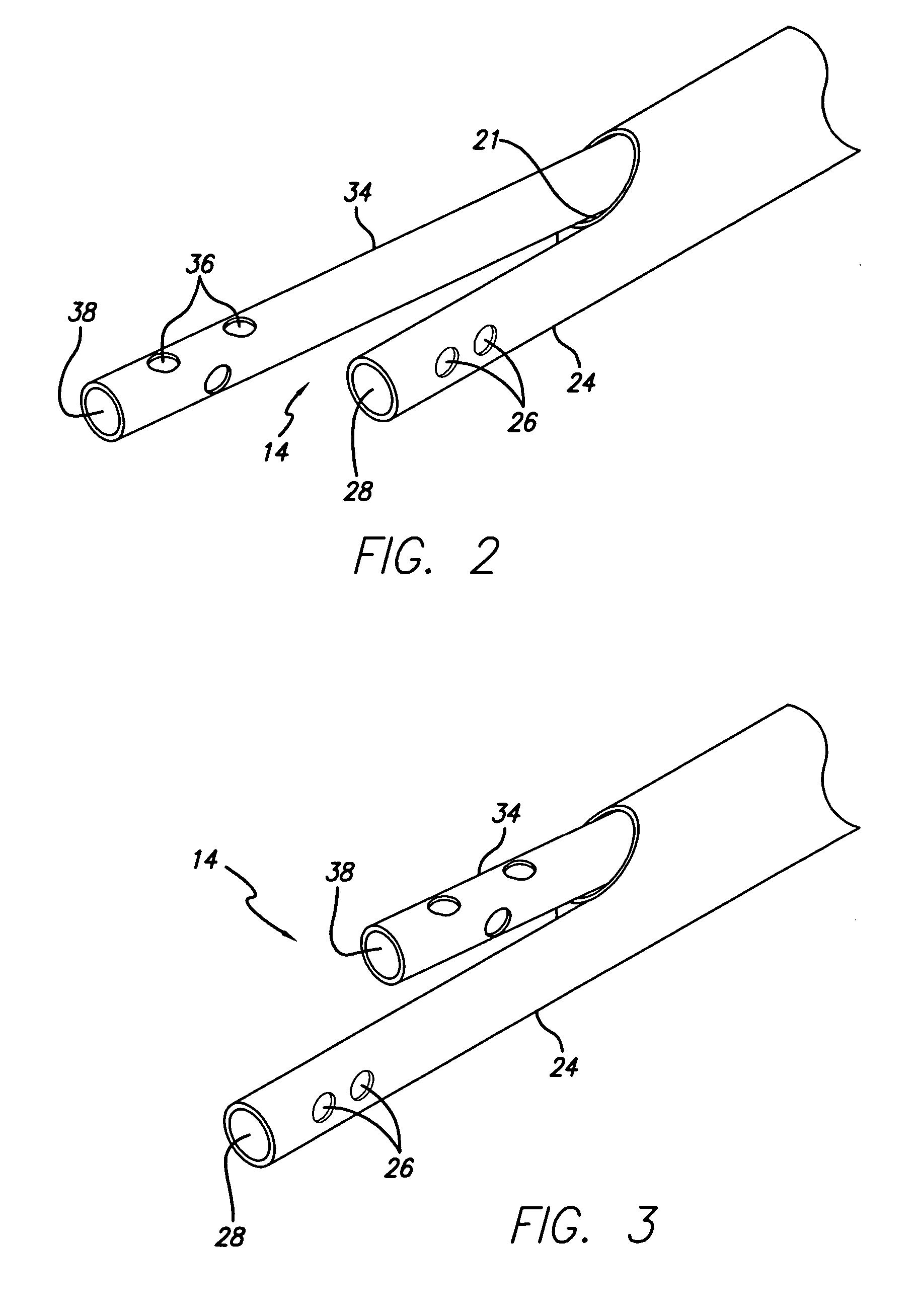 Split tip dialysis catheter