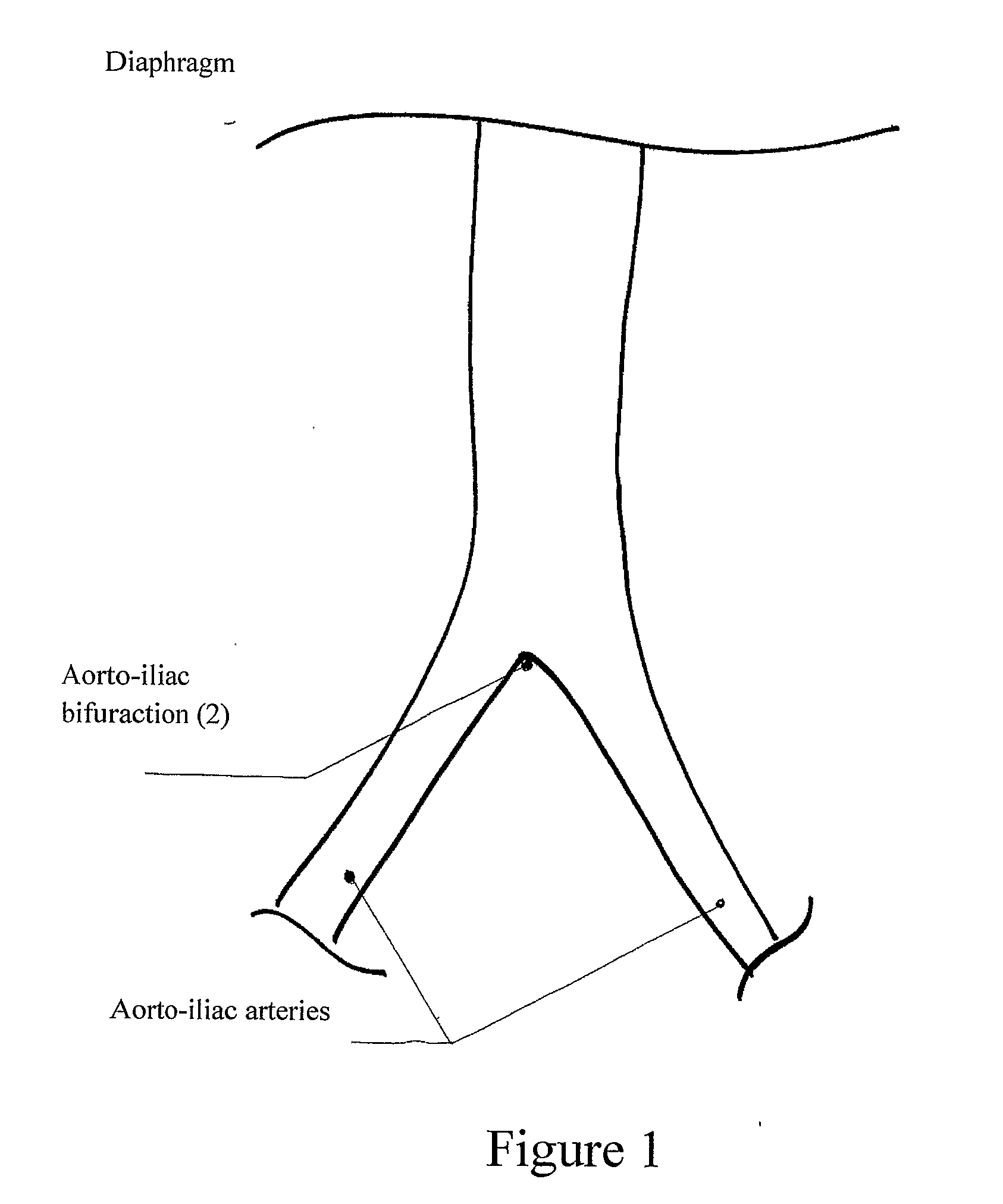 Extra-vascular wrapping for treating aneurysmatic aorta and methods thereof