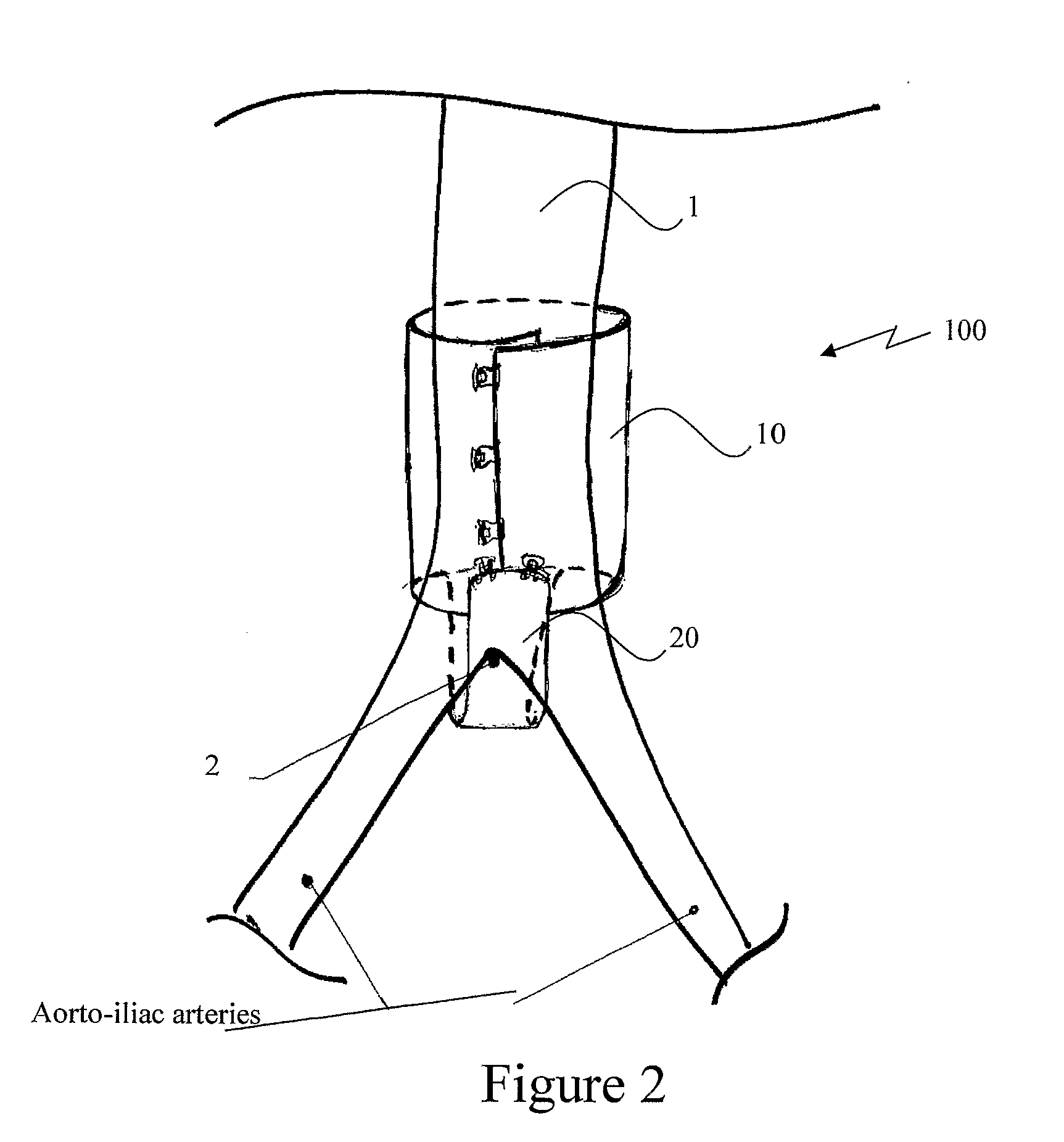 Extra-vascular wrapping for treating aneurysmatic aorta and methods thereof