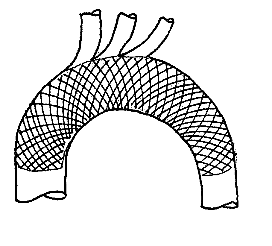 Stent for blood flow improvement