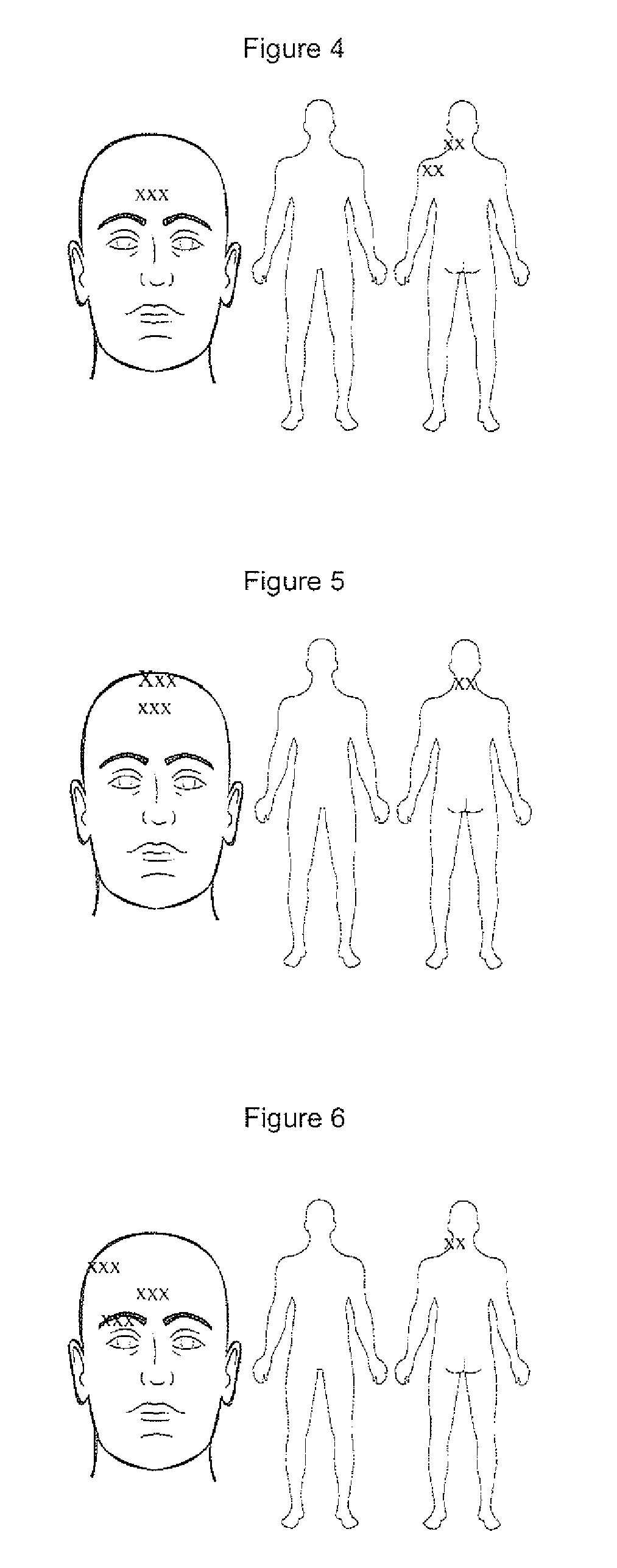 Compositions and methods for treating traumatic brain injury