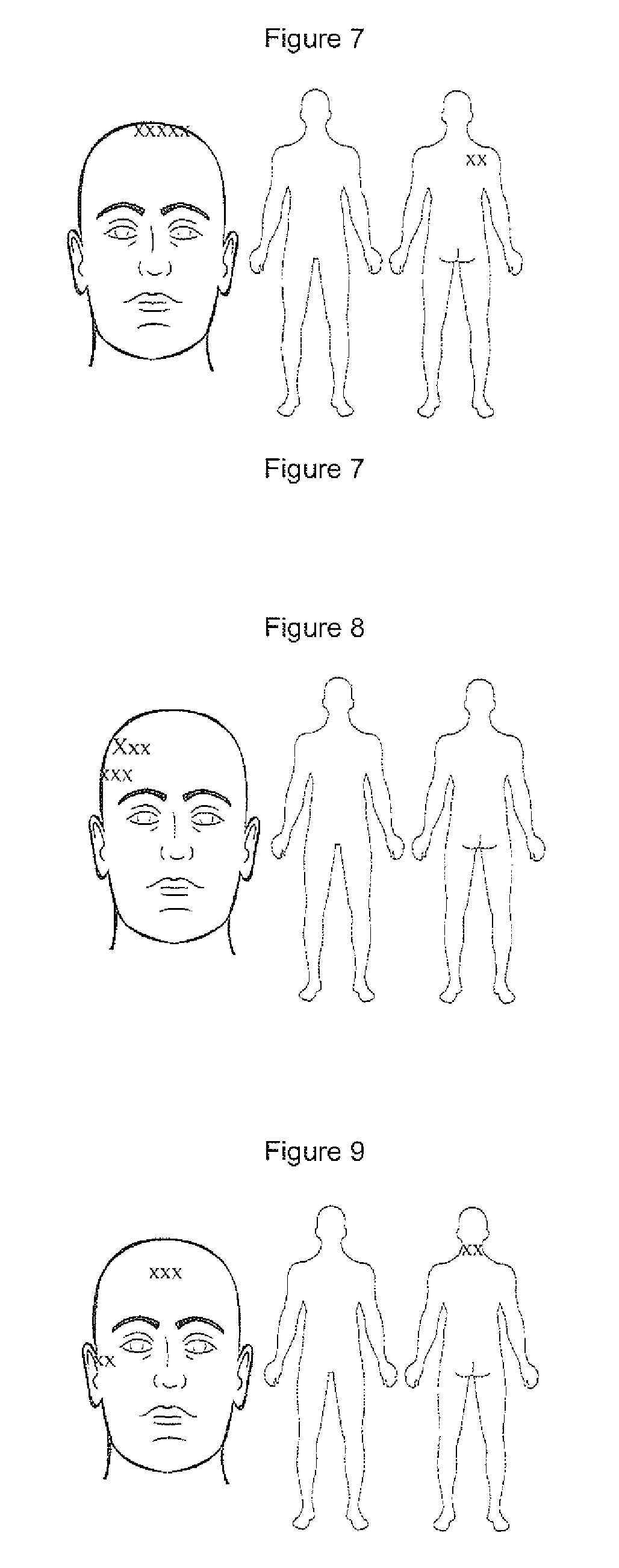 Compositions and methods for treating traumatic brain injury