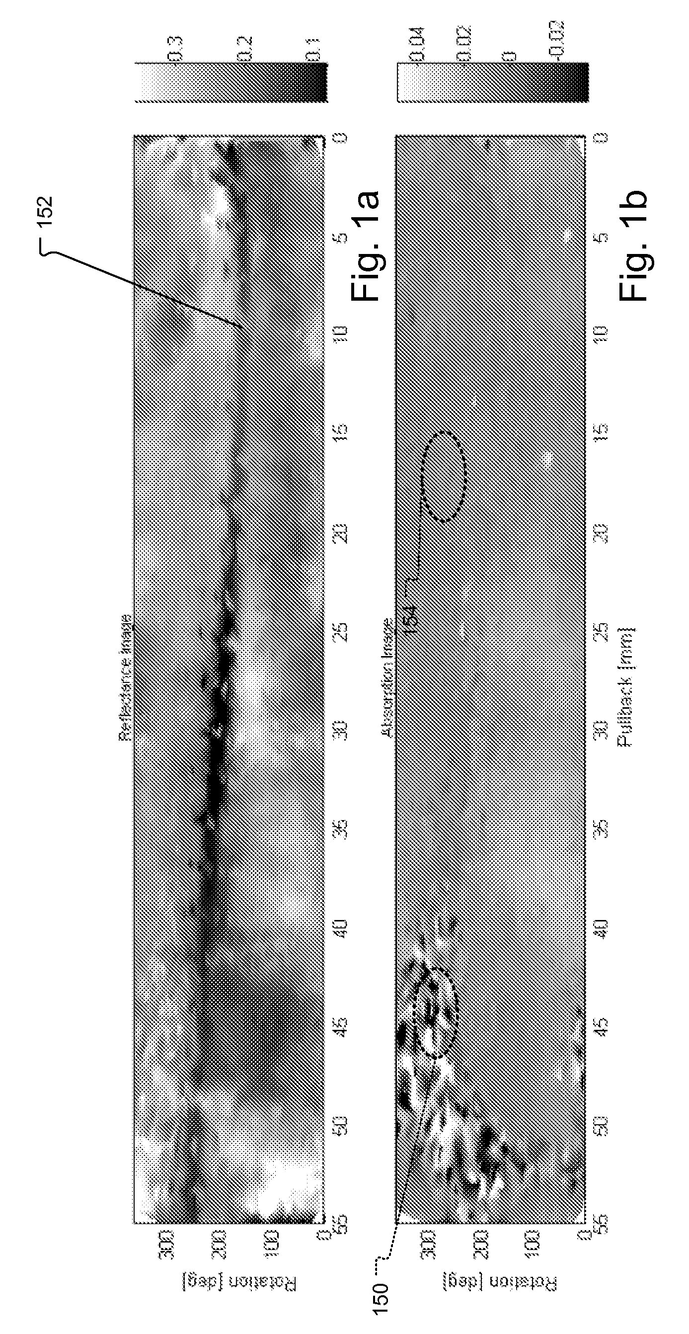 Method and system for intra luminal thrombus detection