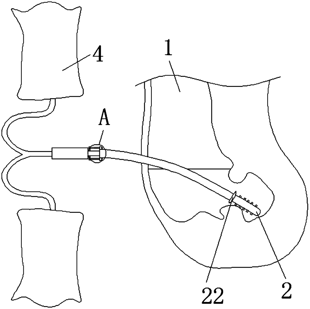 Method for preventing peritoneal dialysis tube from floating and peritoneal dialysis tube with fixed end