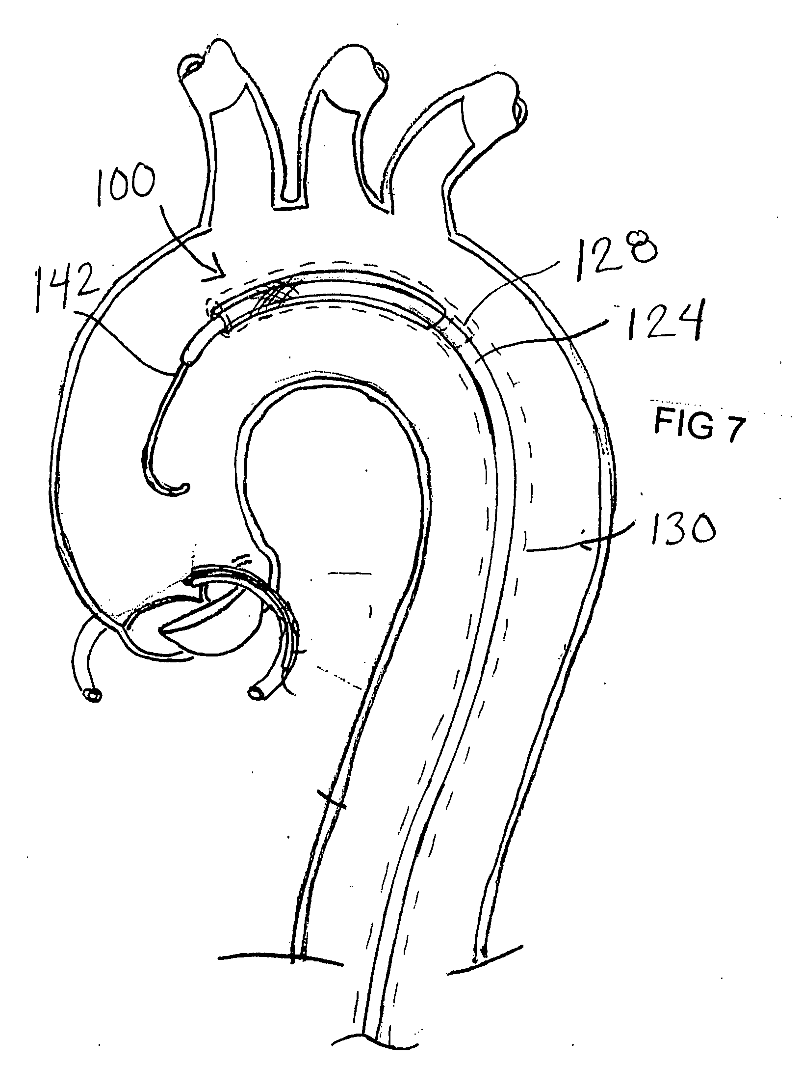 Embolic protection device