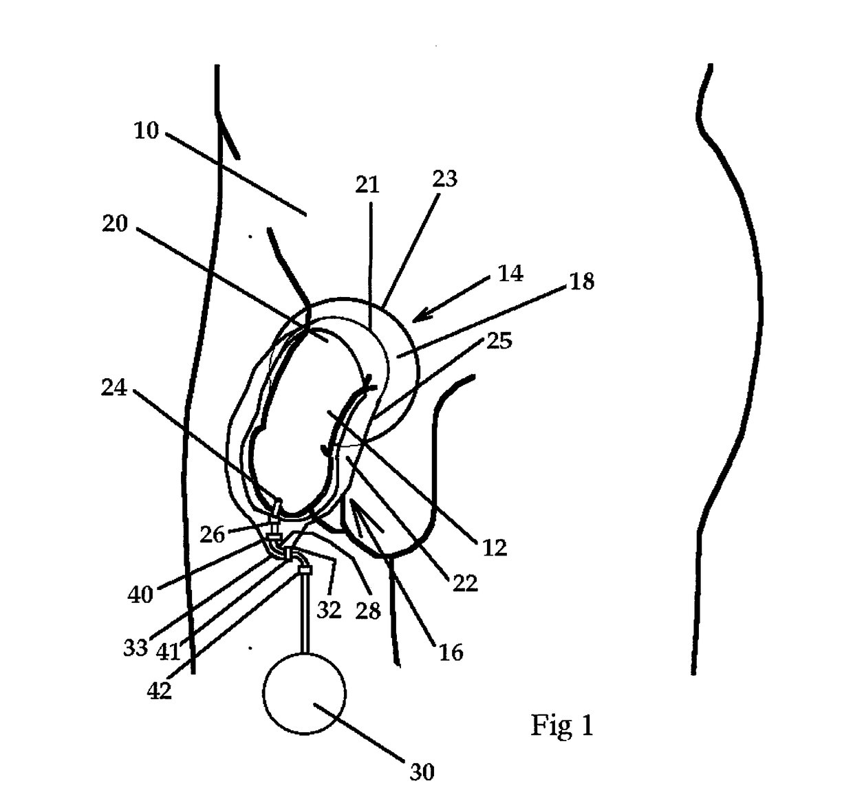 Male external catheter