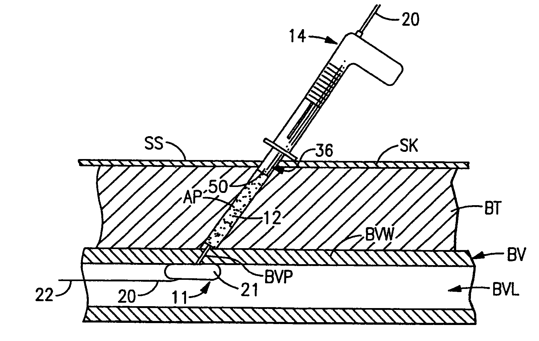 Blood vessel sealing system