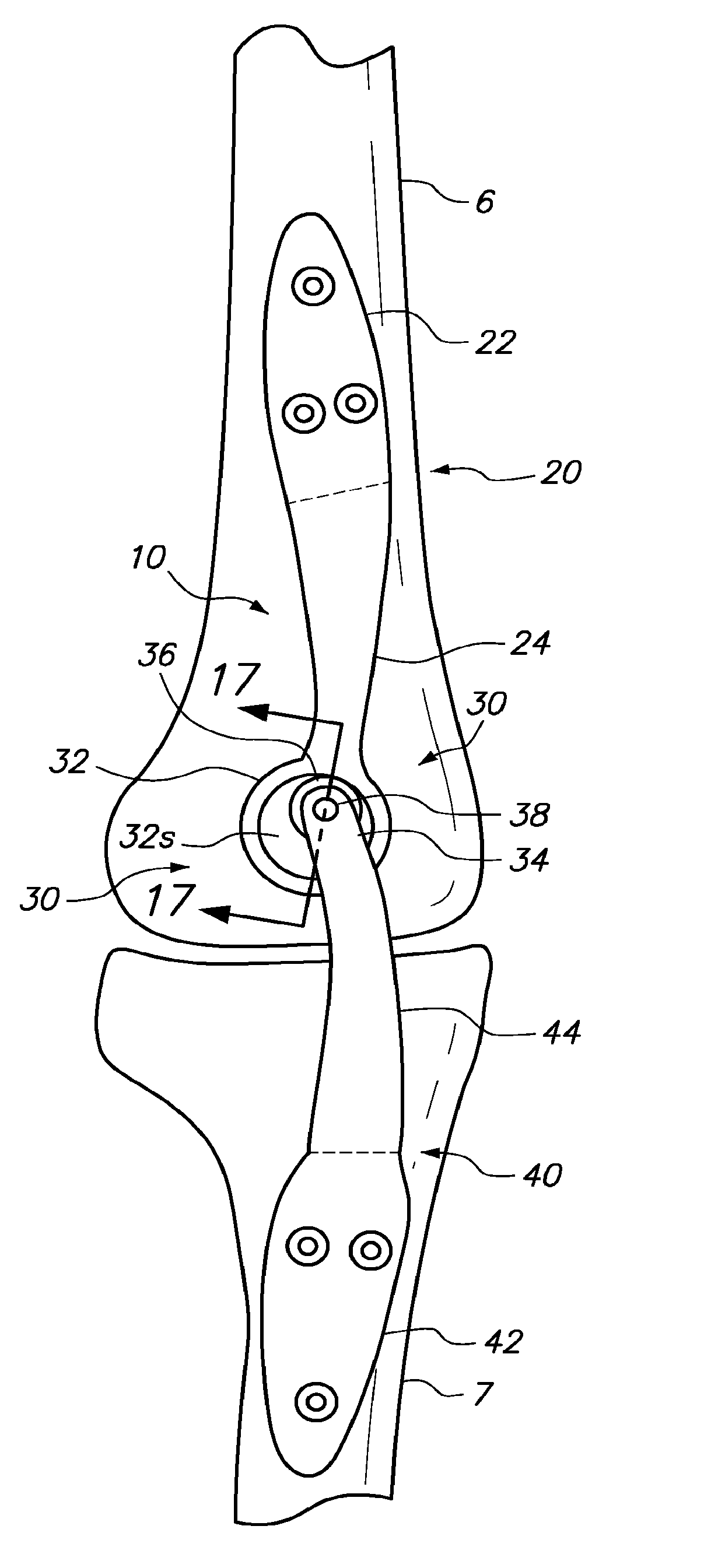 Extra-articular implantable mechanical energy absorbing assemblies having two deflecting members and methods