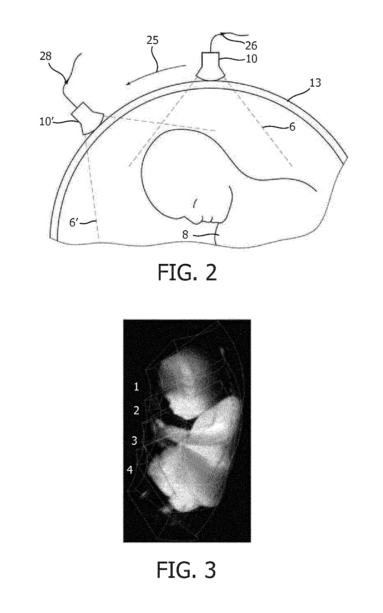 3D image compounding for ultrasound fetal imaging