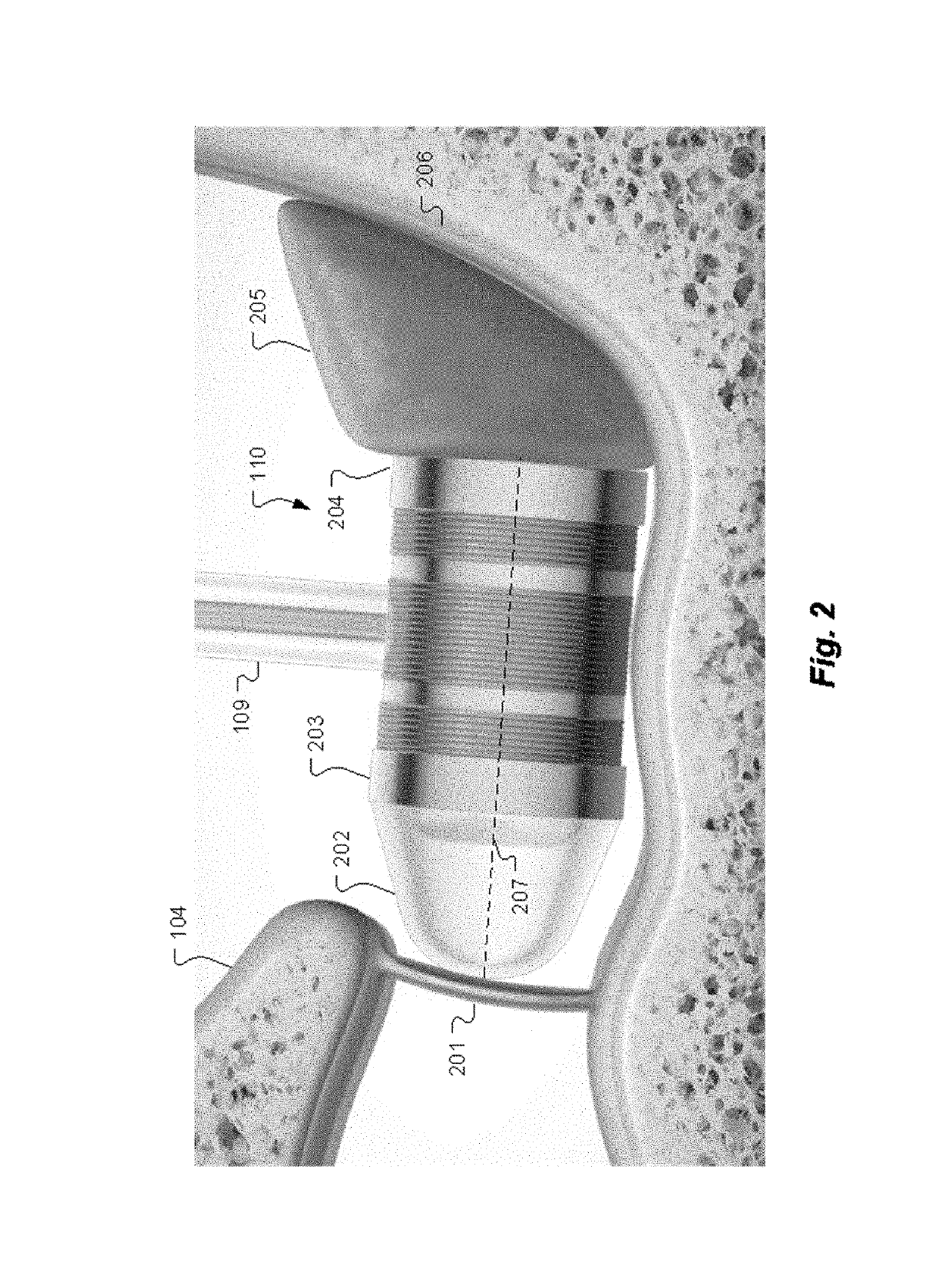 Pre-load feedback of a middle-ear coupler