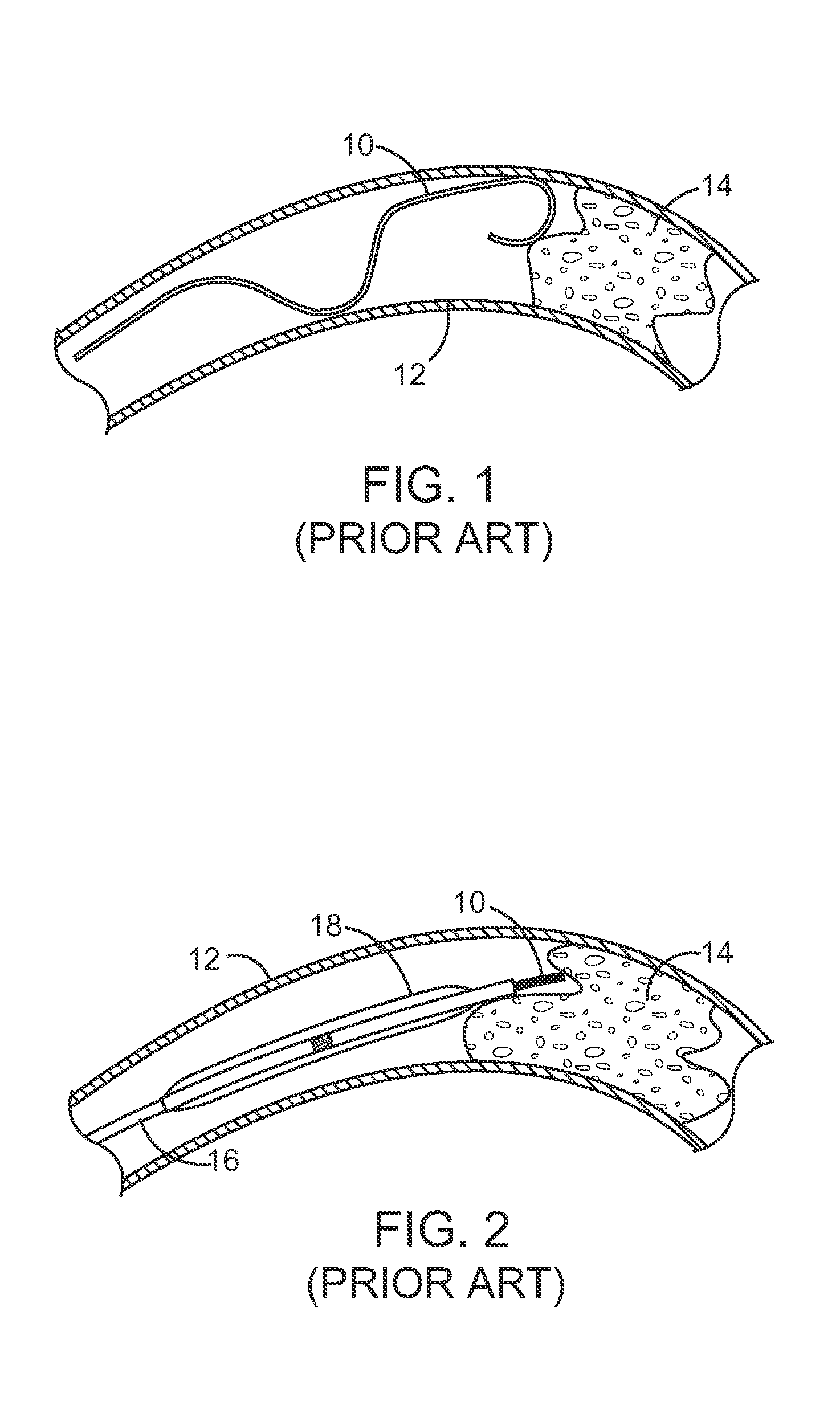 Drug-Eluting Device for Treatment of Chronic Total Occlusions