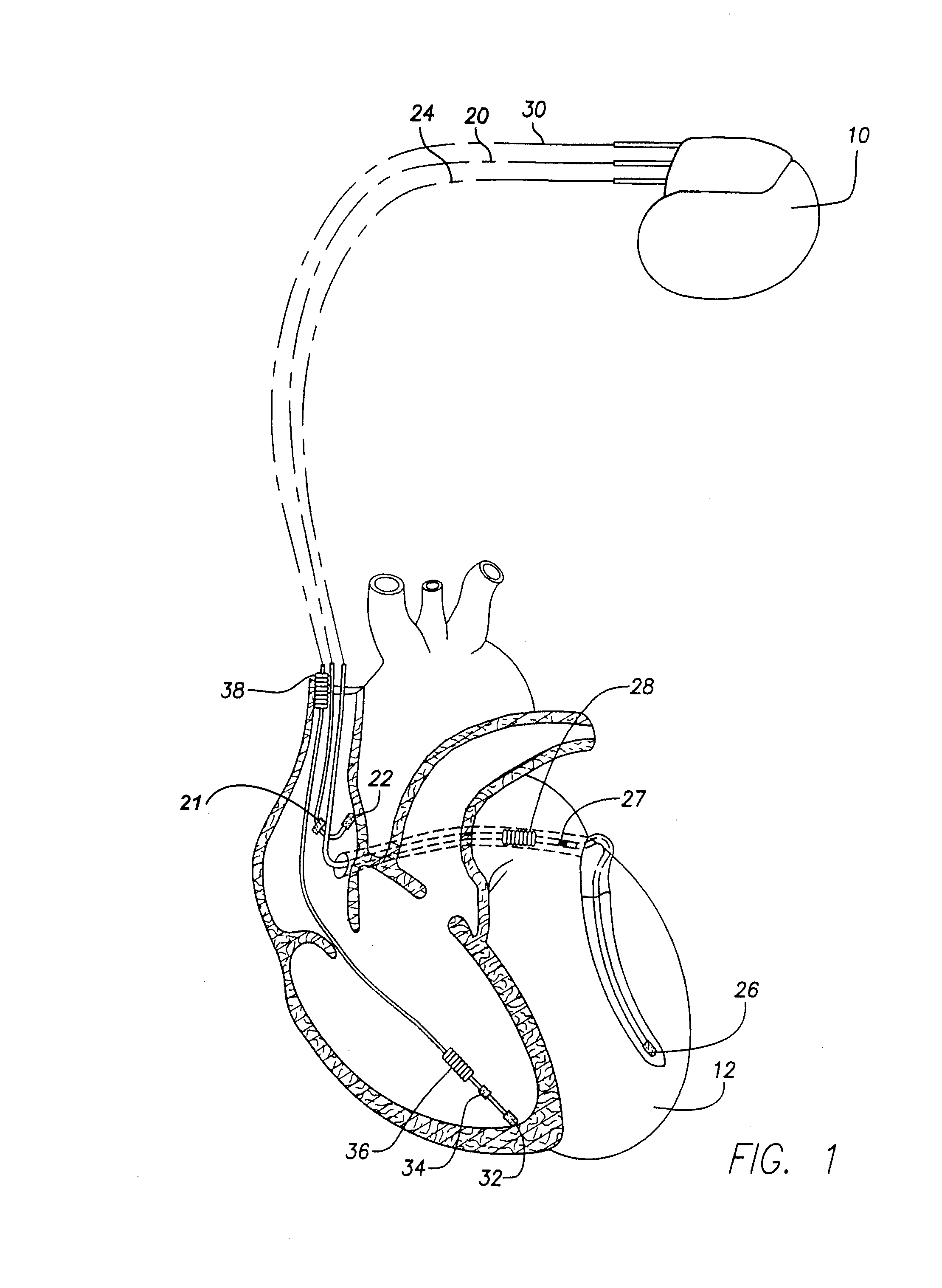 Systems and methods for preventing, detecting, and terminating pacemaker mediated tachycardia in biventricular implantable cardiac stimulation systems