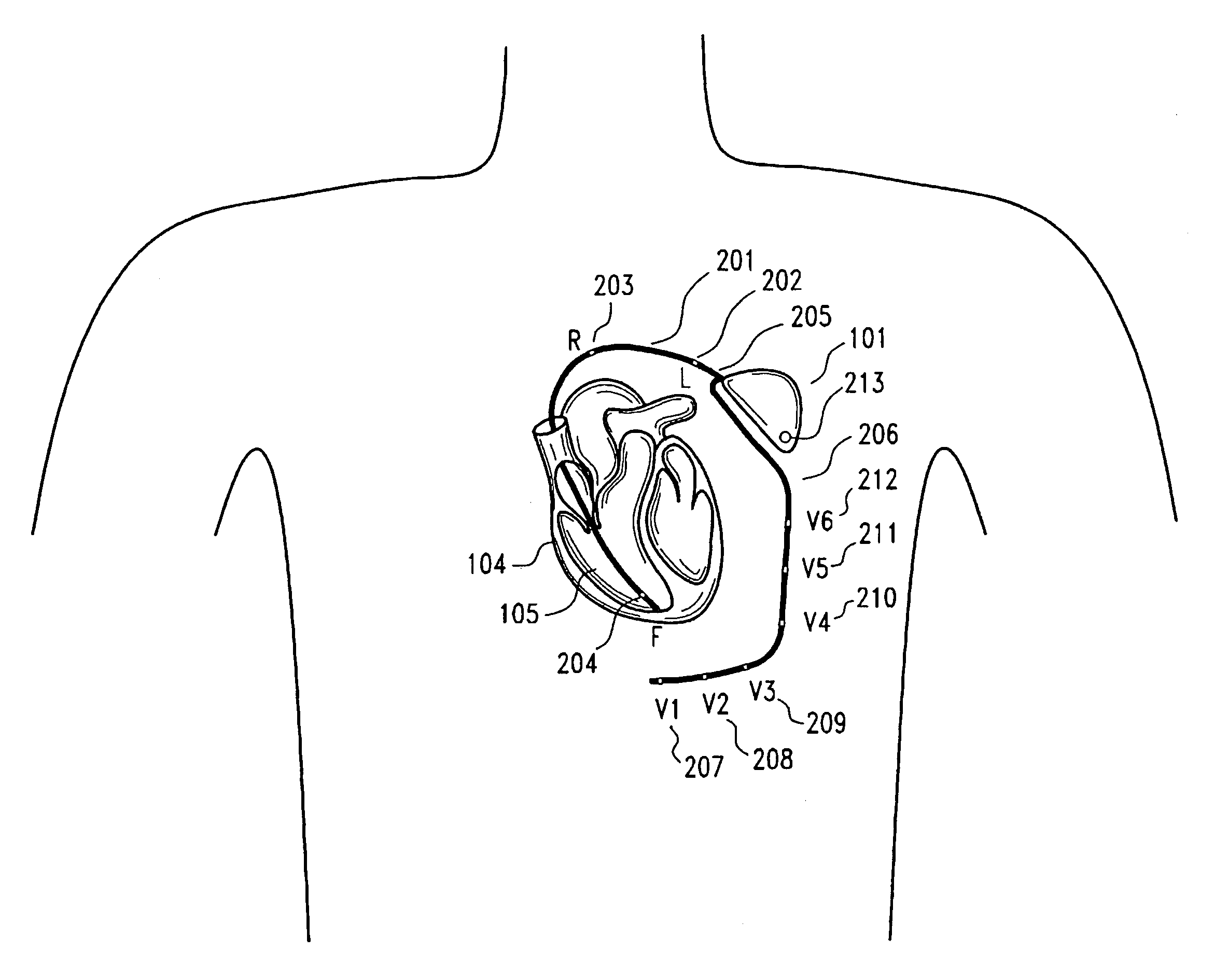 Implantable myocardial ischemia detection, indication and action technology