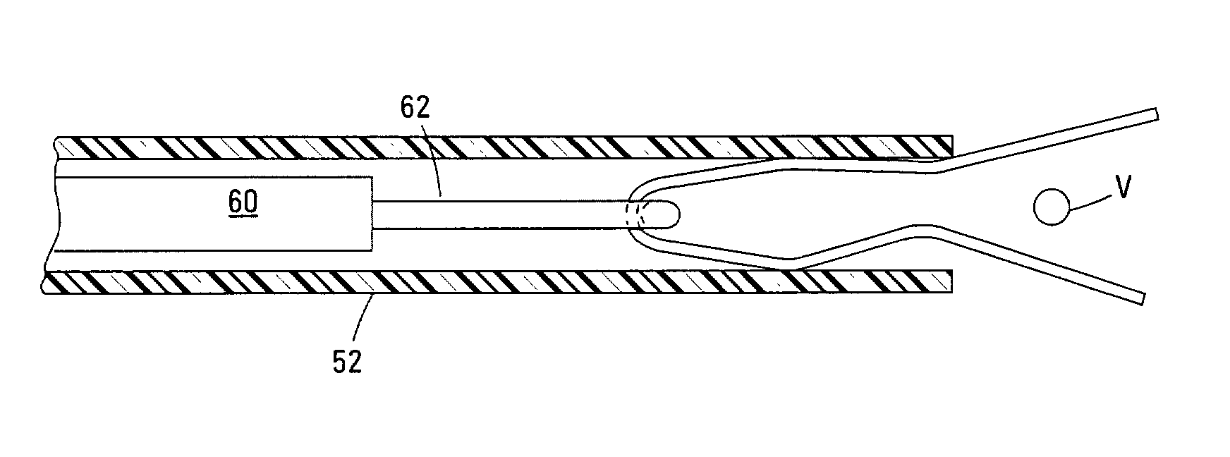 Non-invasive surgical ligation clip system and method of using