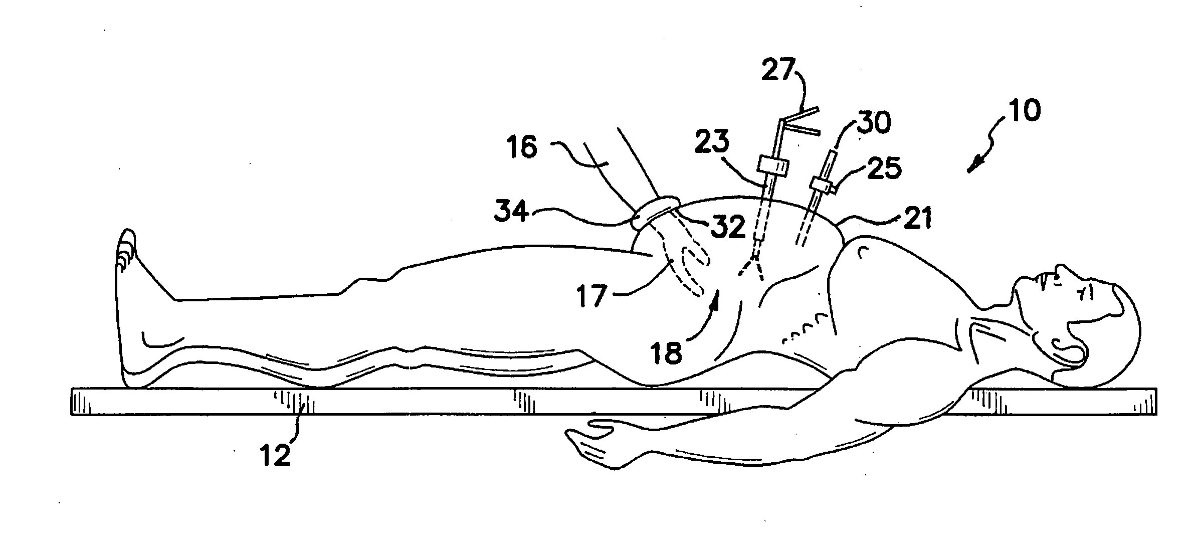 Surgical access system