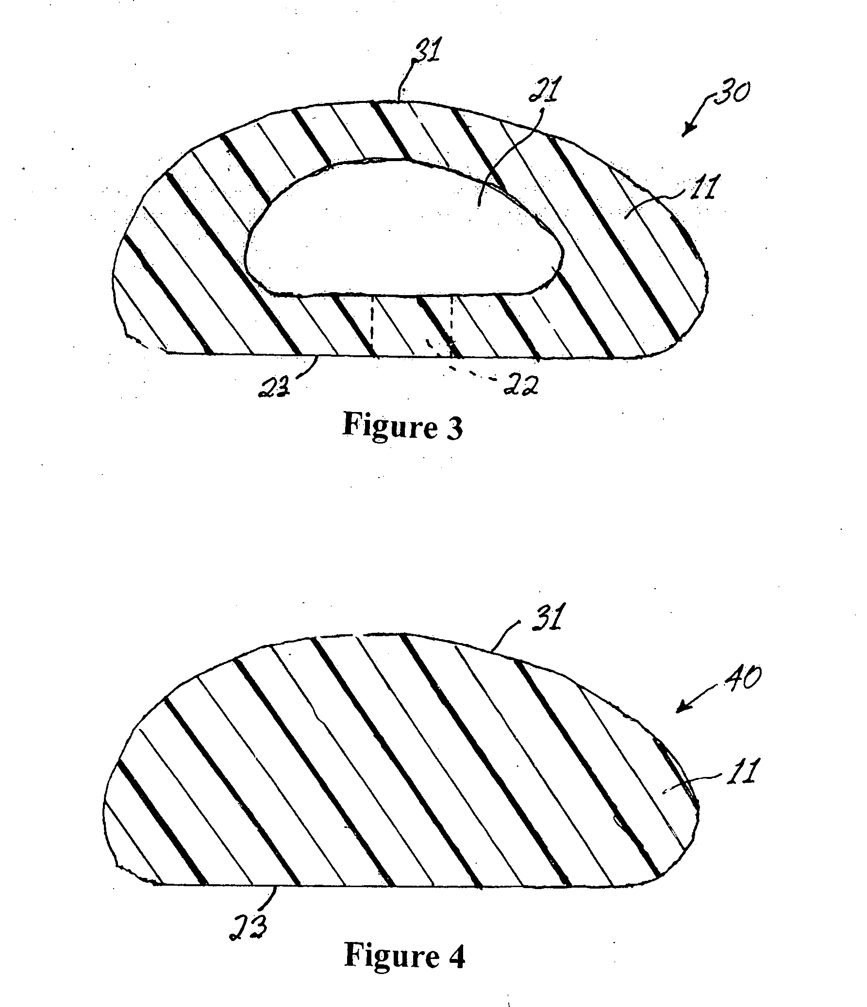 Leak-proof breast implant