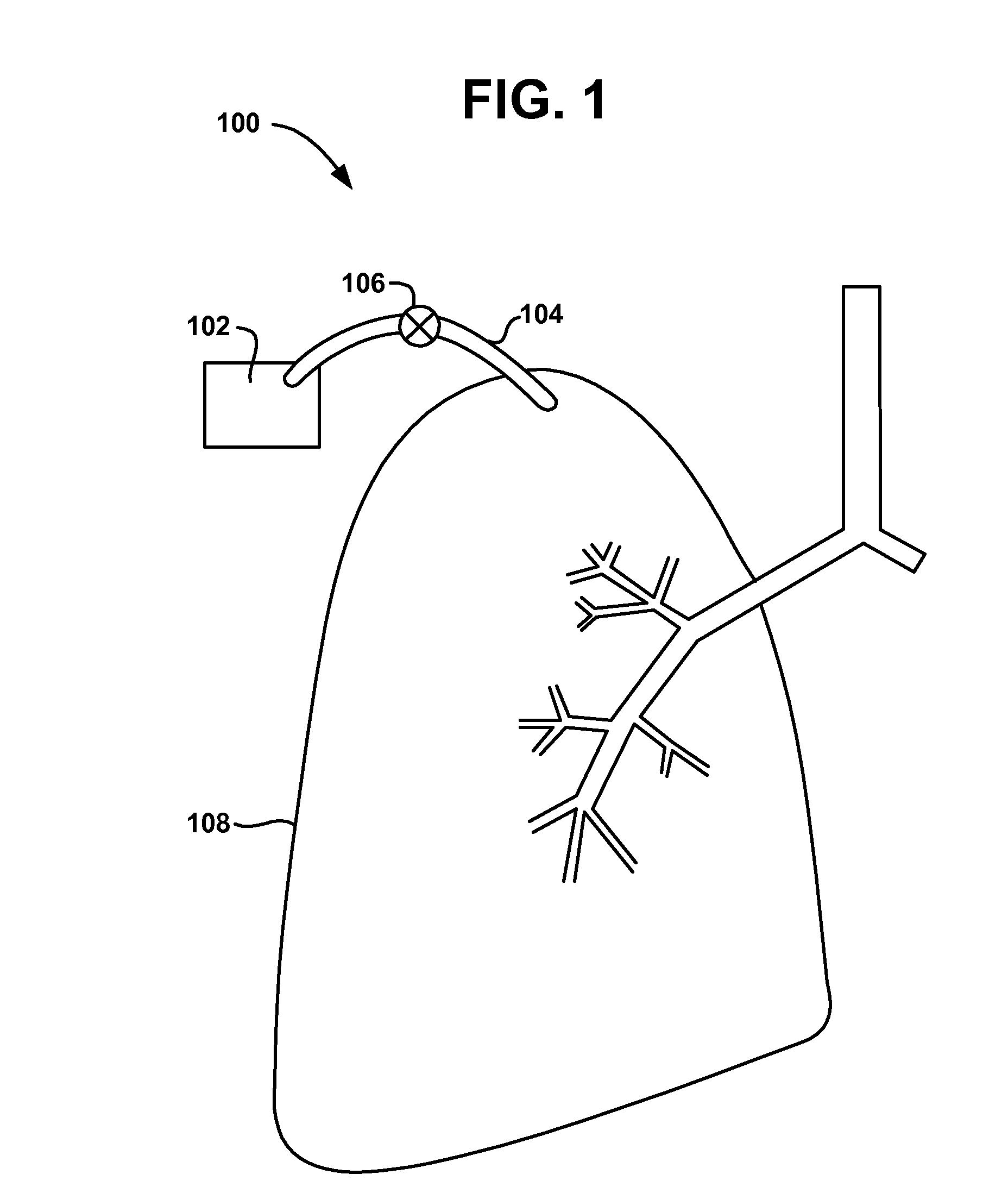 Pulmonary visceral pleura anastomosis reinforcement