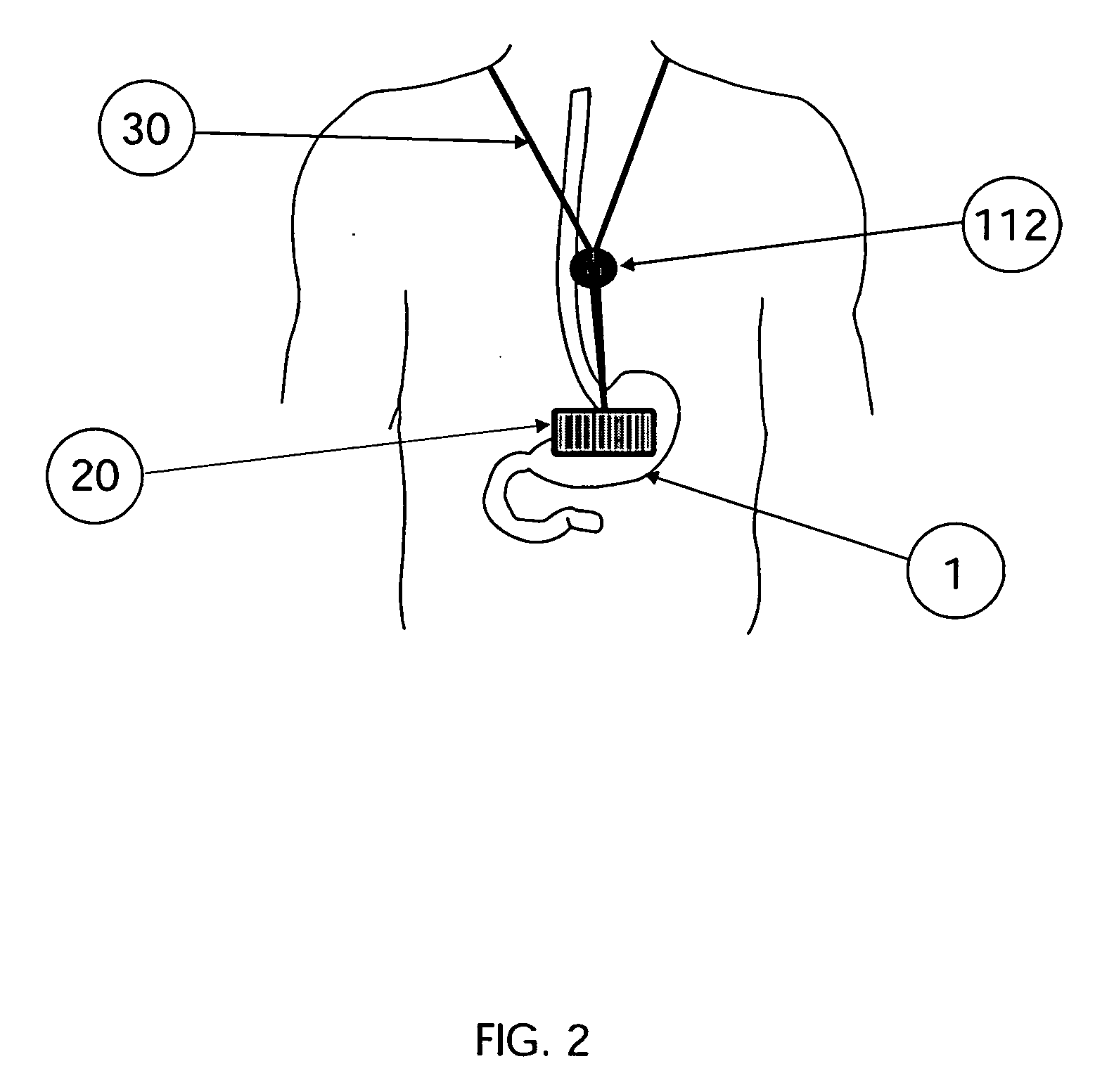 Method and device for treating obesity by suppressing appetite and hunger using vibration