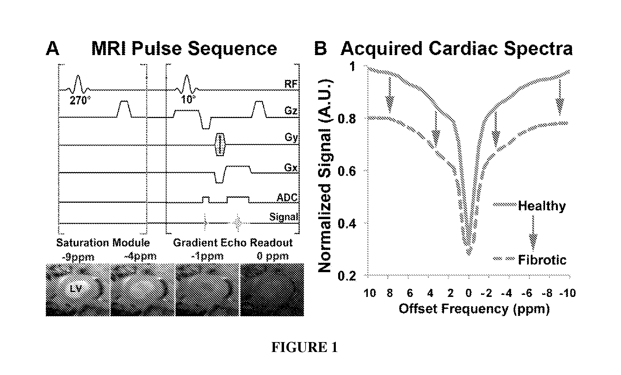 Magnetic resonance imaging for detecting cardiac diseases