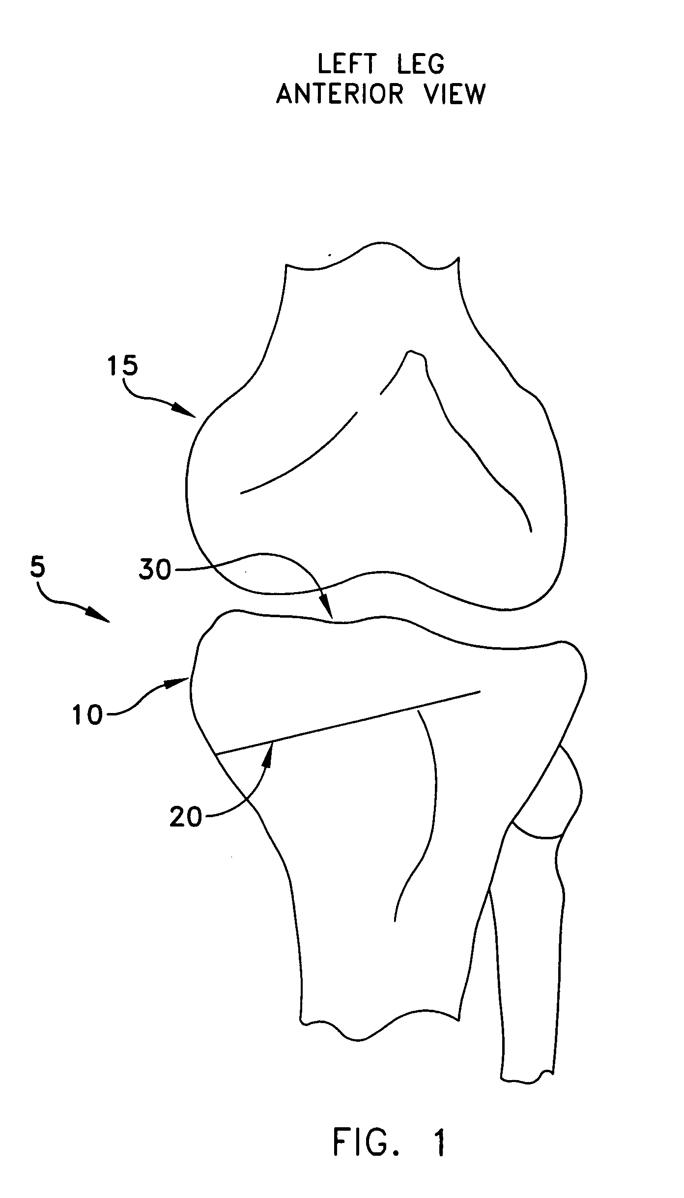 Method and apparatus for performing an open wedge, high tibial osteotomy