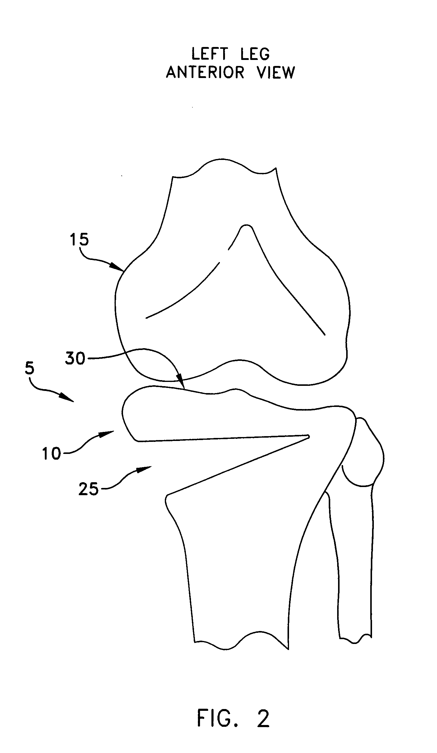 Method and apparatus for performing an open wedge, high tibial osteotomy