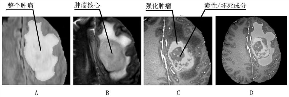 MRI brain tumor automatic segmentation method of double-flow decoding convolutional neural network based on edge feature optimization