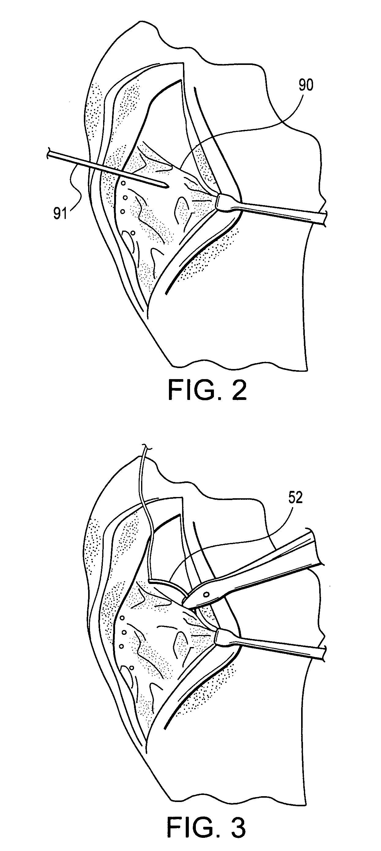 Method and suture needle construct for cruciate ligament repair