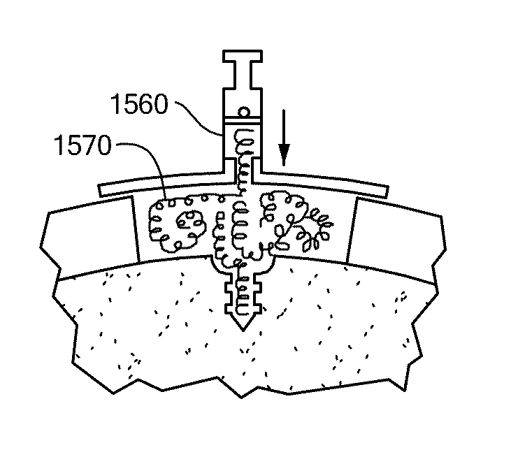 Patient Selectable Joint Arthroplasty Devices and Surgical Tools