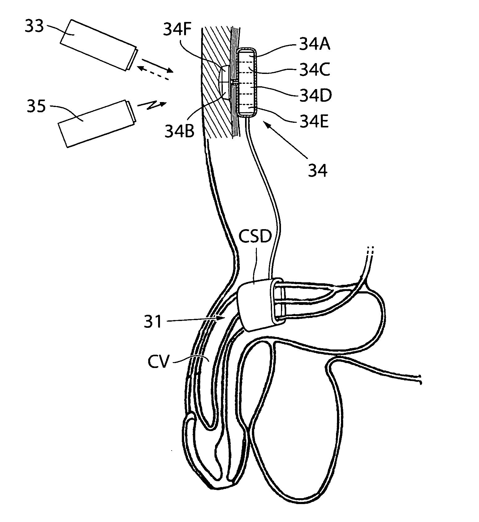 Method for controlling flow in a bodily organ