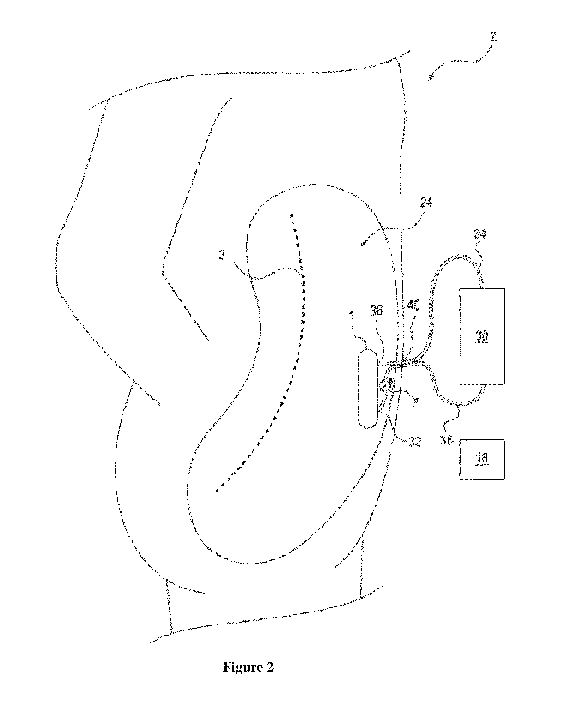 Method and device to treat kidney disease