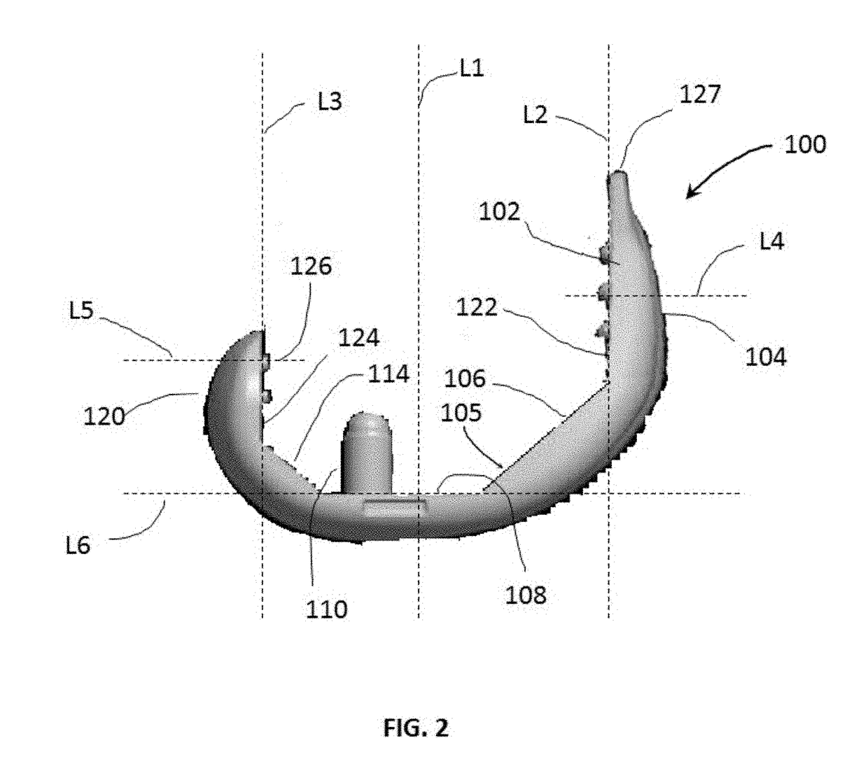 Flexible snap-fit prosthetic component