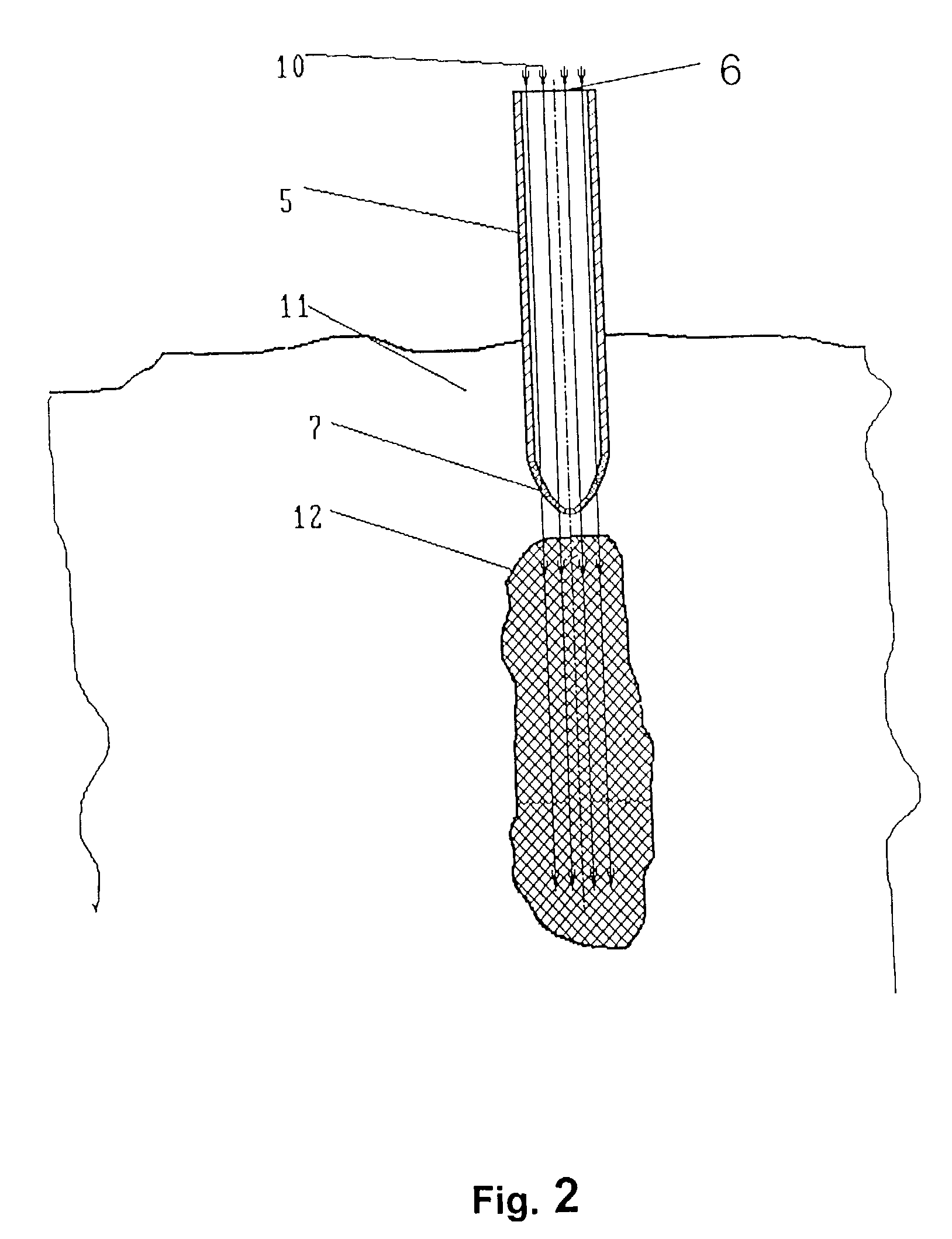 Device for radiation therapy